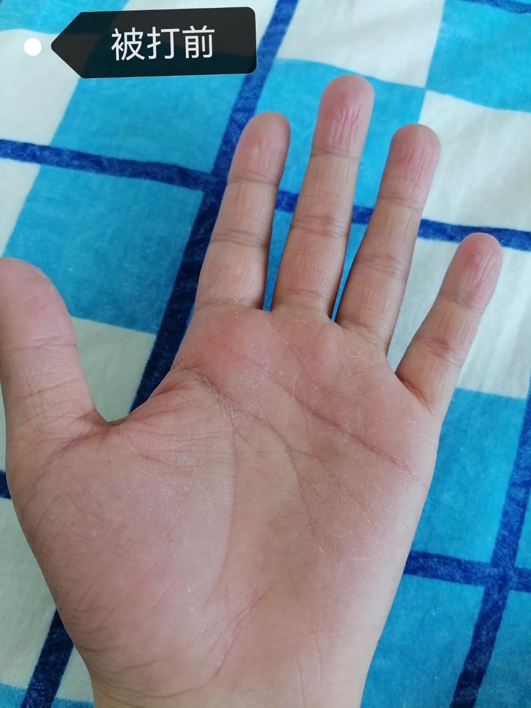 考试考砸了放假回家被打手心50下,打的挺用力的,现在手又红又肿握拳