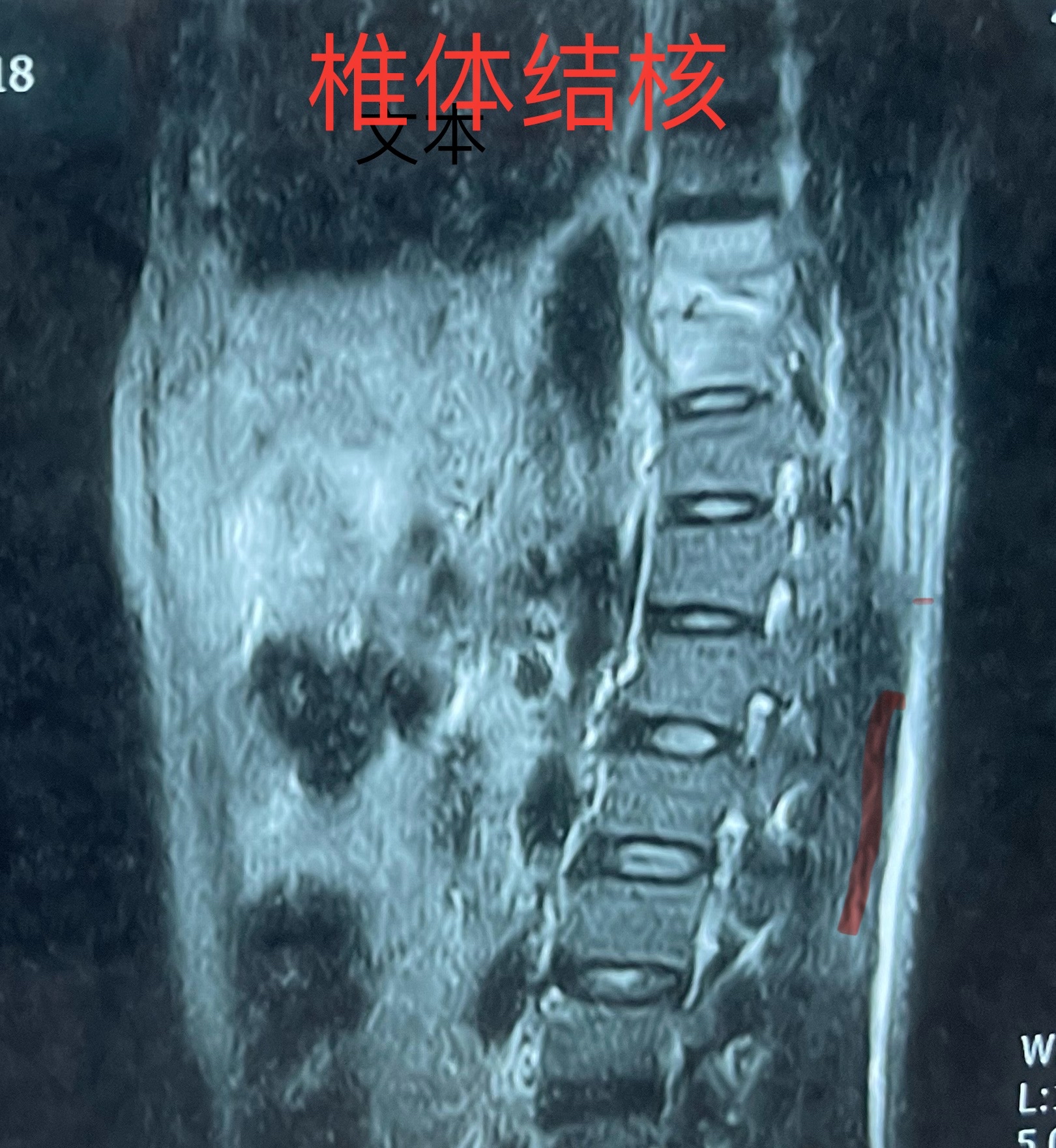 椎体楔形变图片