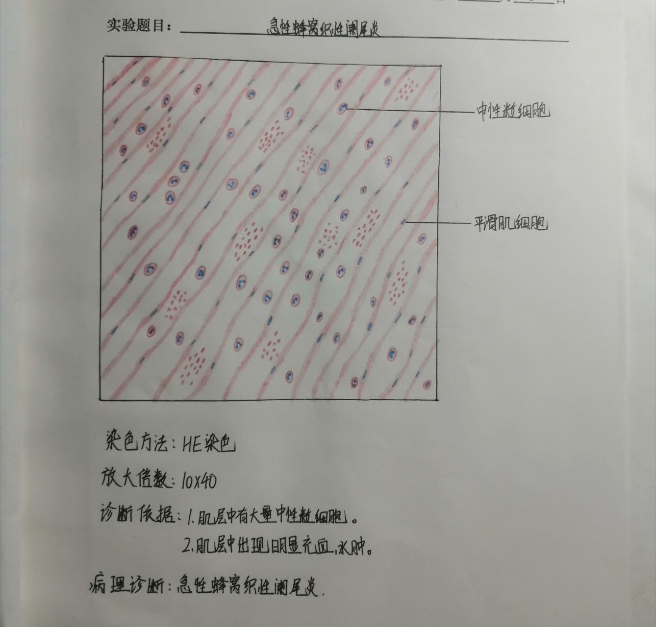 急性蜂窝织性阑尾炎切片图