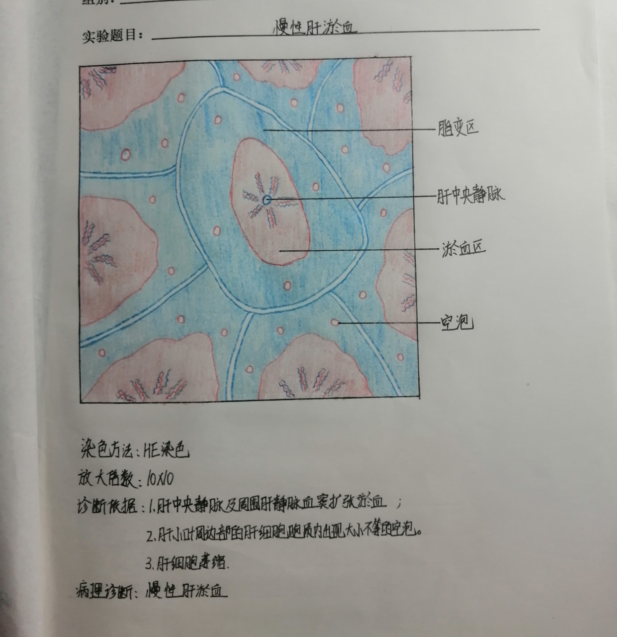 慢性肝淤血切片图