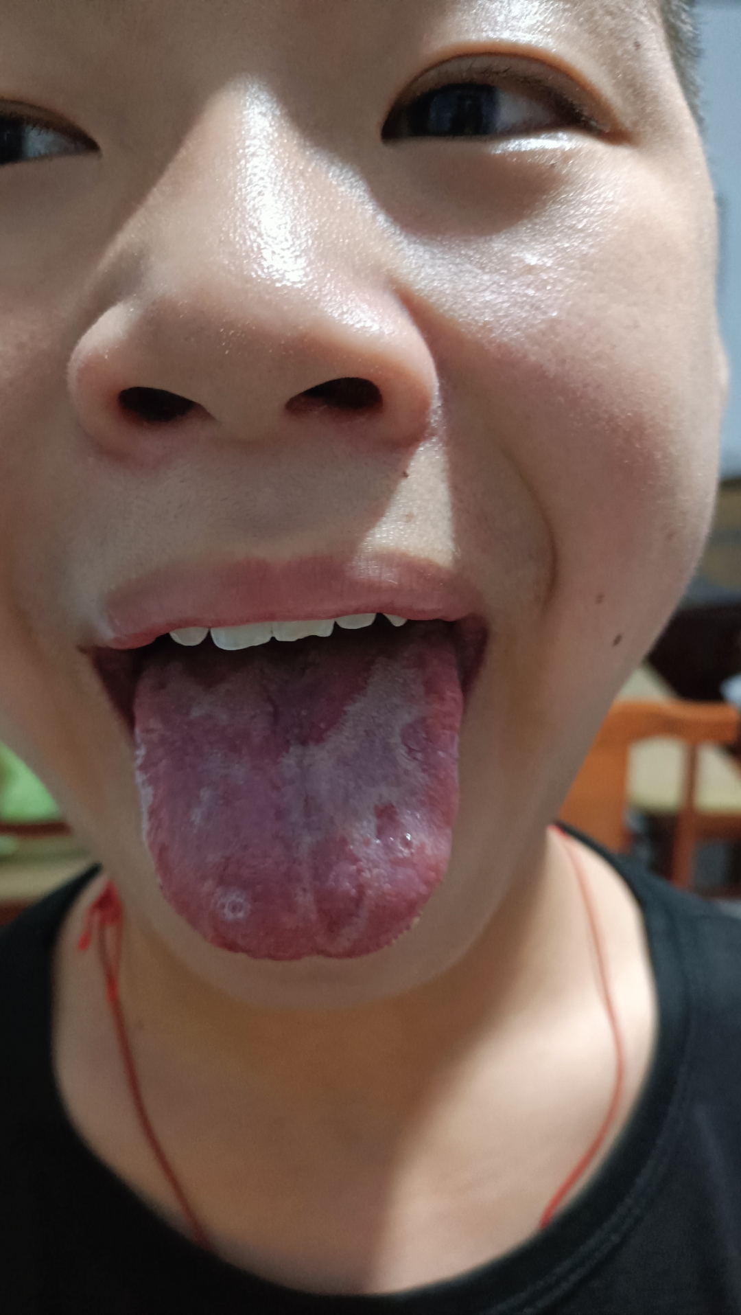 请问孩子舌苔这样是怎么回事?