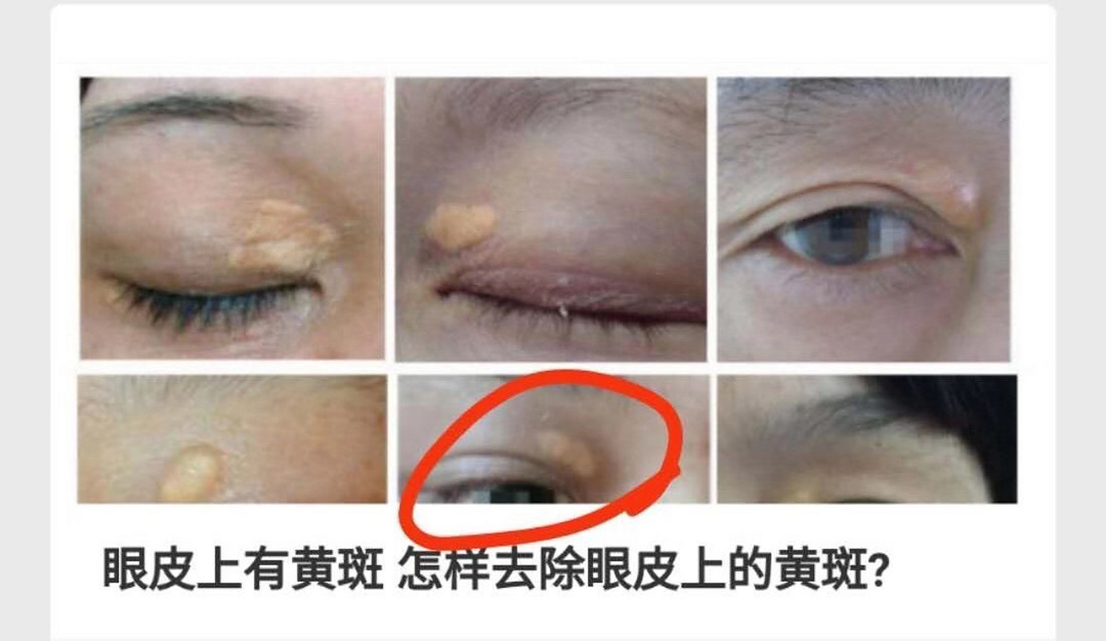 睑黄疣又称睑黄瘤!是黄瘤中最常见的.