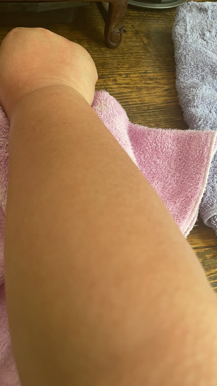 早起,我的胳膊废了!从去年冬天扭伤后,一直没有彻底痊愈!