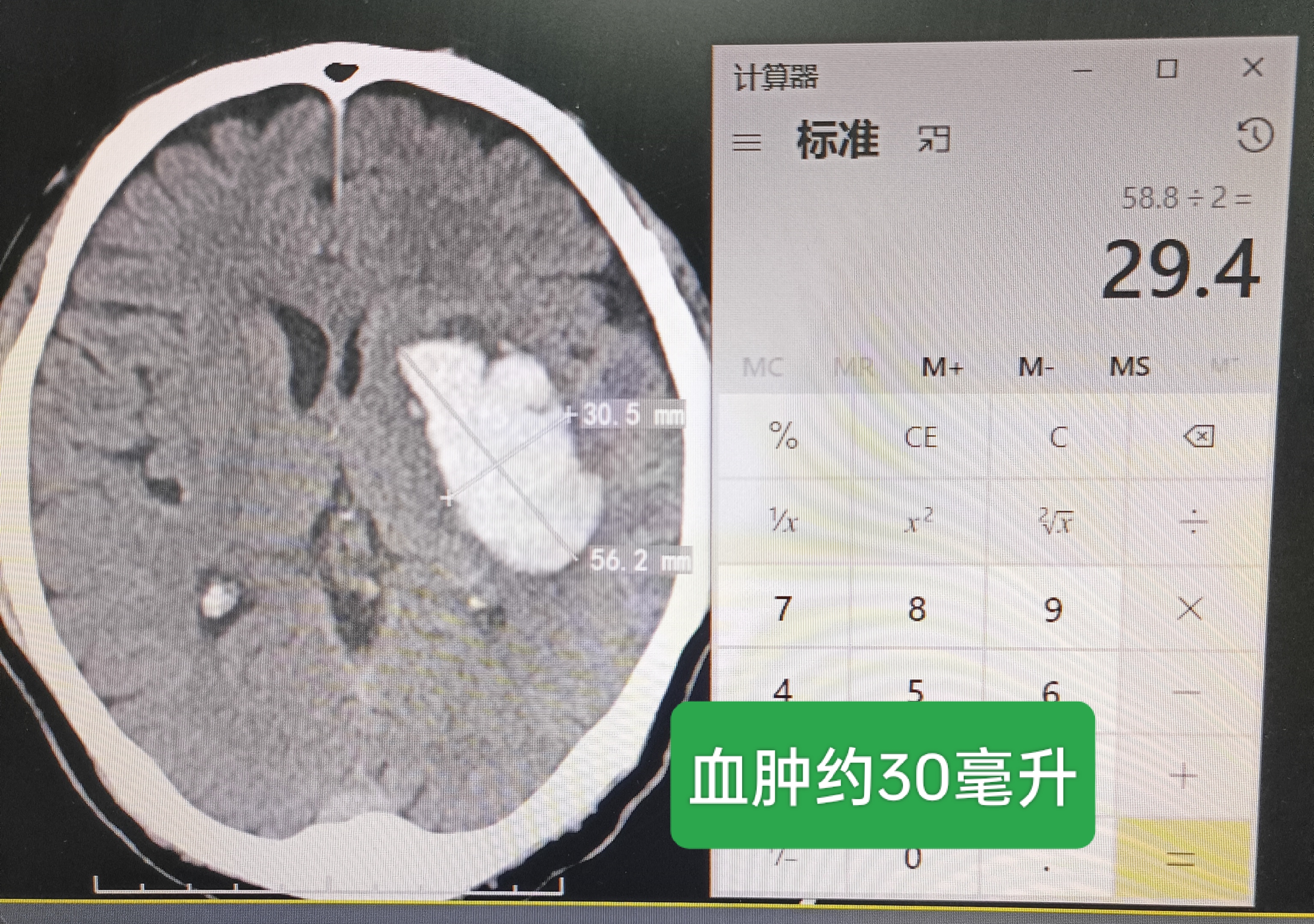 基底节区脑出血图片图片