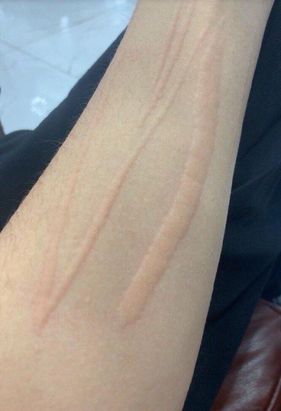 挠了一下挠过的地方,皮肤就冒起来了,就像肿了一样