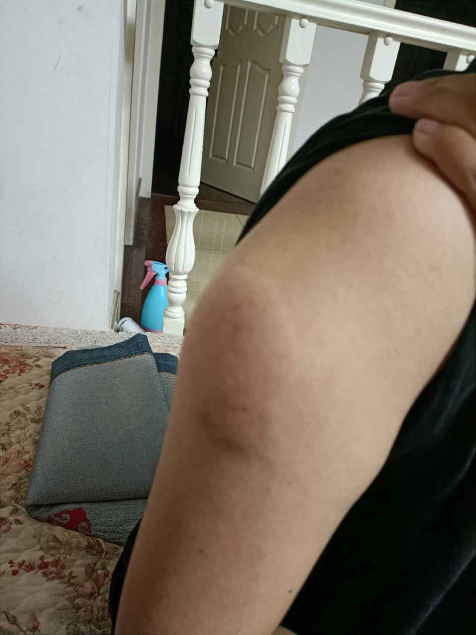 8月31号打的安徽智飞第三针,又肿又痒又硬有和我一样反应的吗?[捂脸]