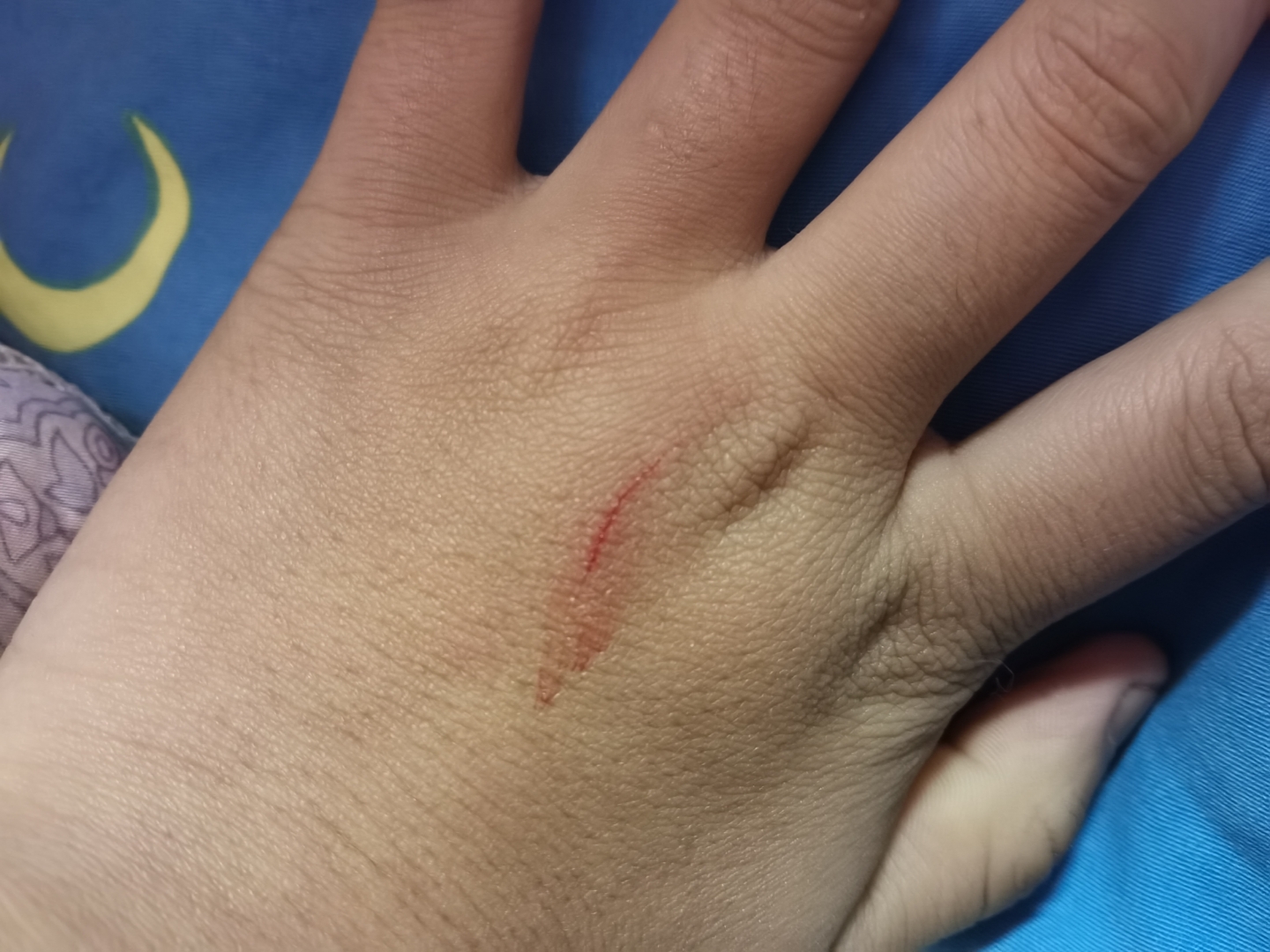 又被猫抓了!要打针吗?