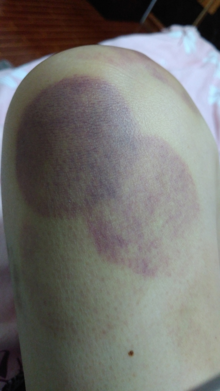 大前天右腿一处痛点固定不移,(此前也是右腿但不是同一位置),自己扎