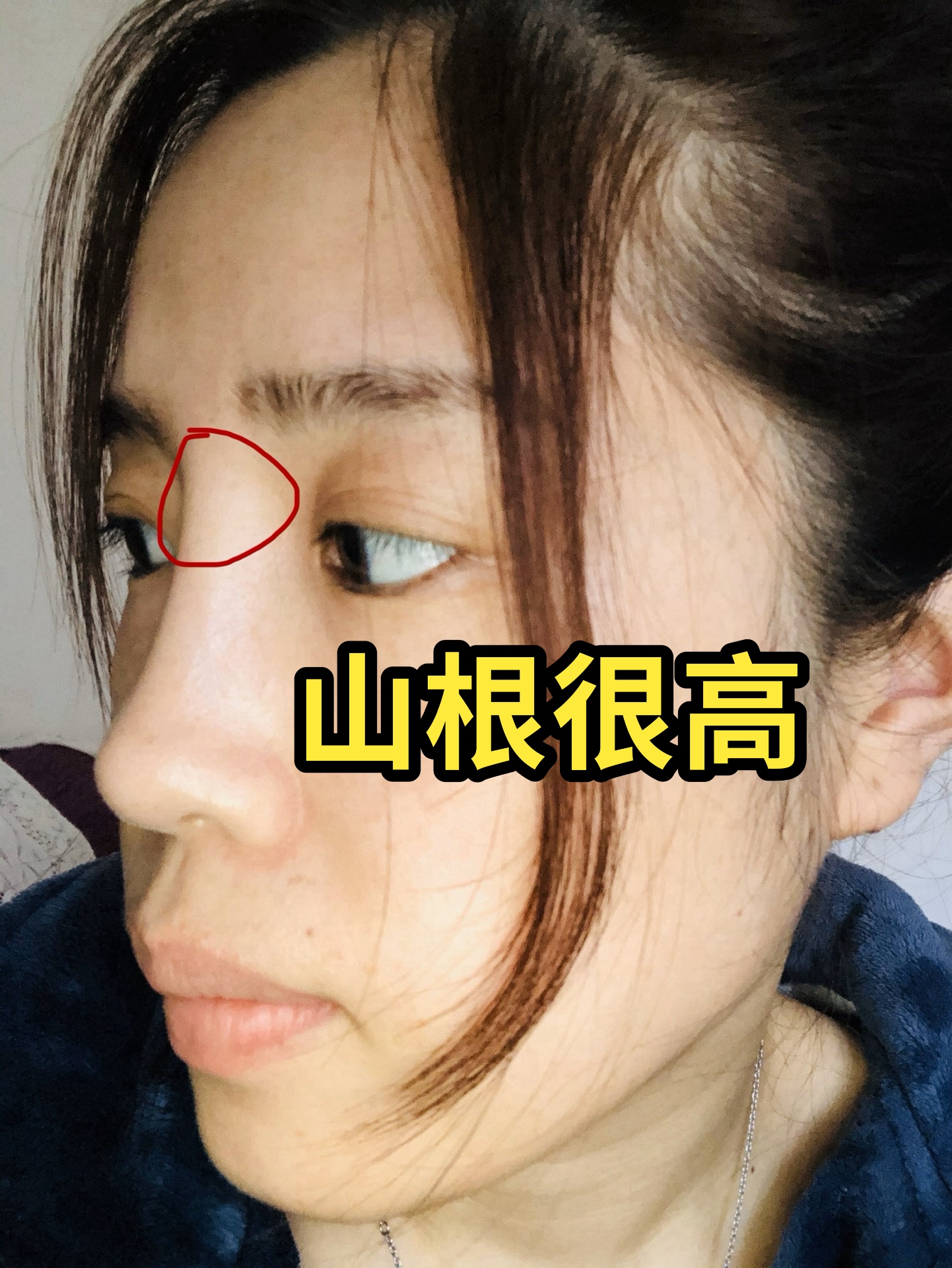 女人山根后天出现横纹图片