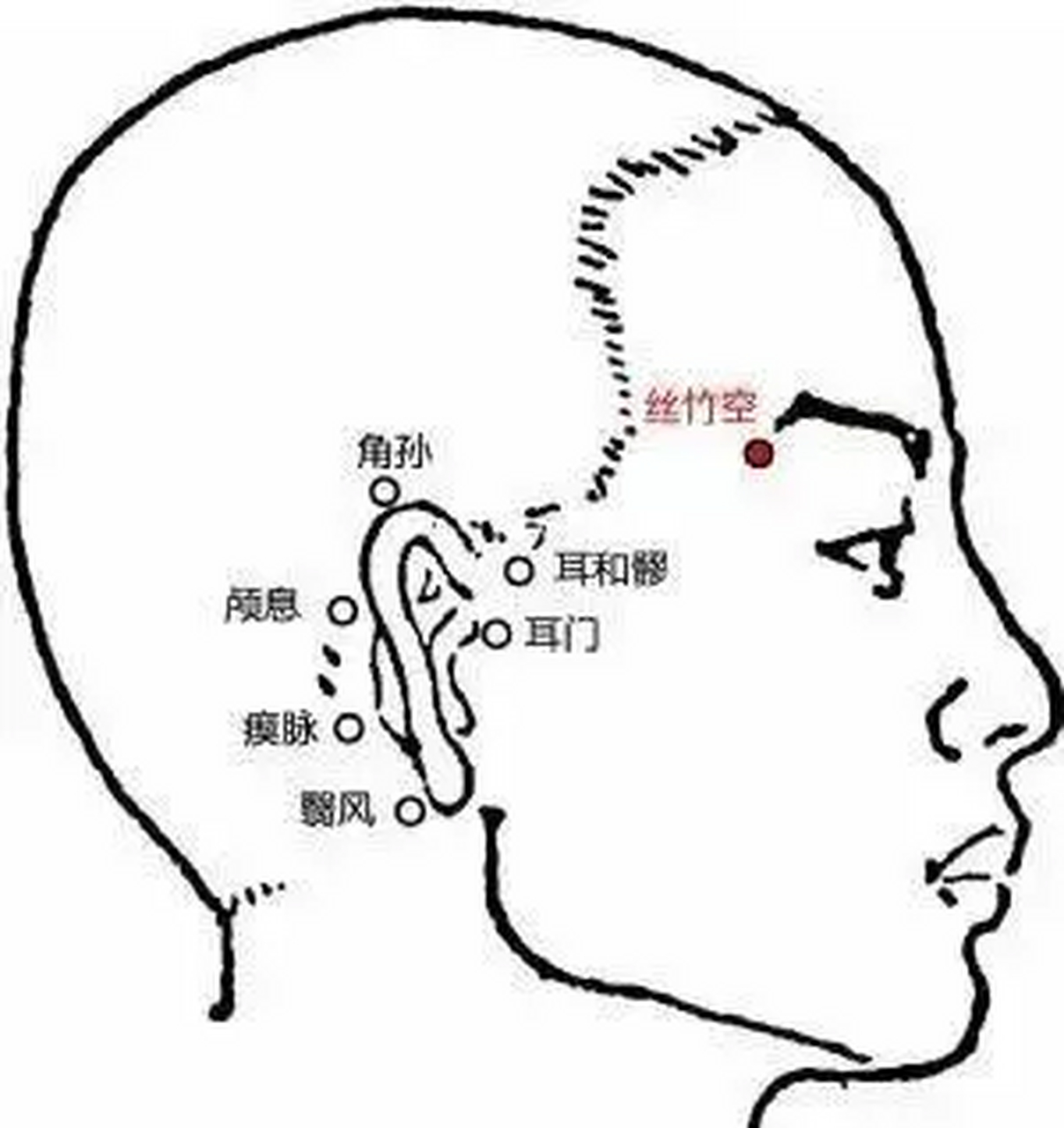 穴位按摩 治疗 失眠 有效穴位①丝竹空穴 作用:宁心安神(位于