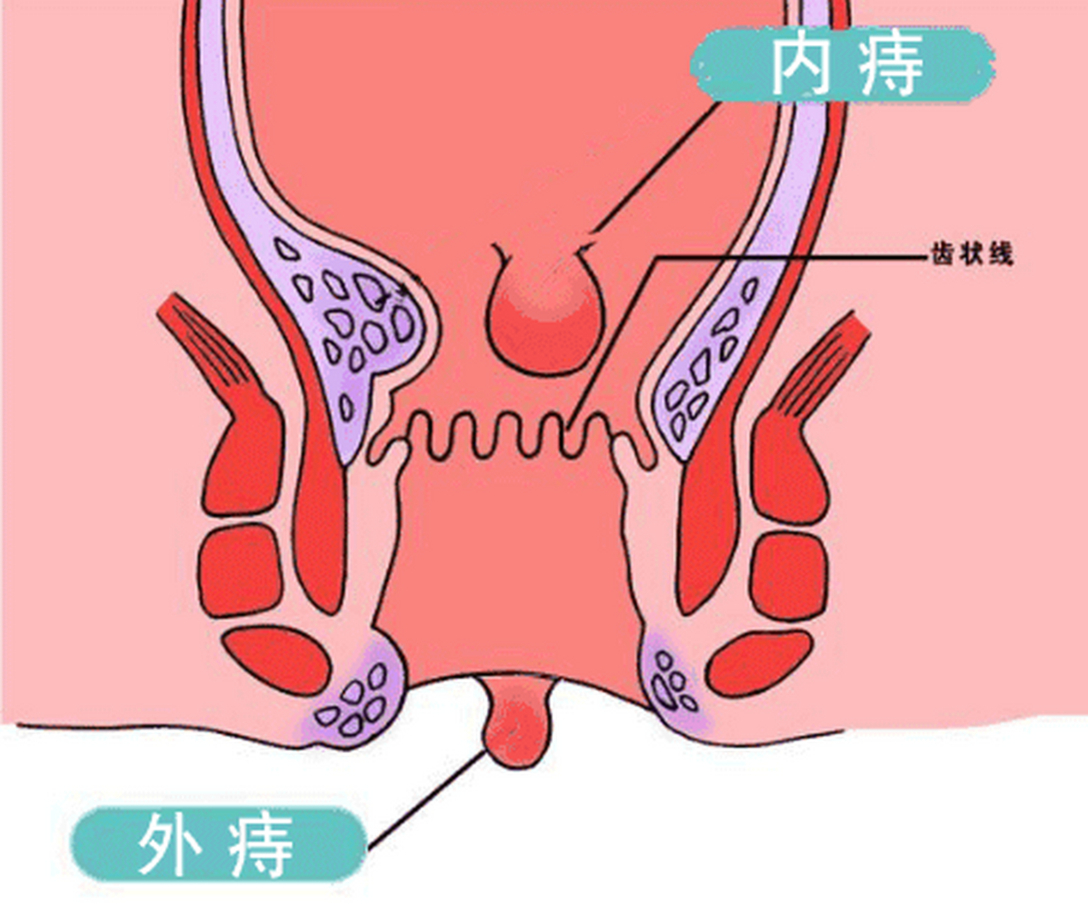 痔疮-称痔,痔疾,痔漏,我是来说说又是怎么回事 痔疮-称痔,是