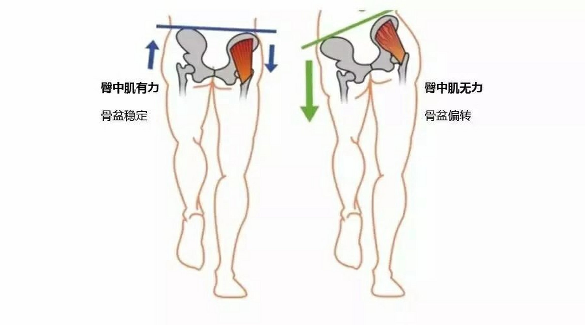 臀肌无力产生的影响 而如果臀肌失衡的话,身体就会被迫进入代偿的