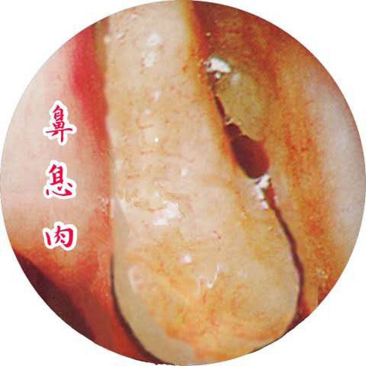 鼻息肉是实体肉,它是不会像鼻甲那样可以收缩或变大的 鼻息肉是从