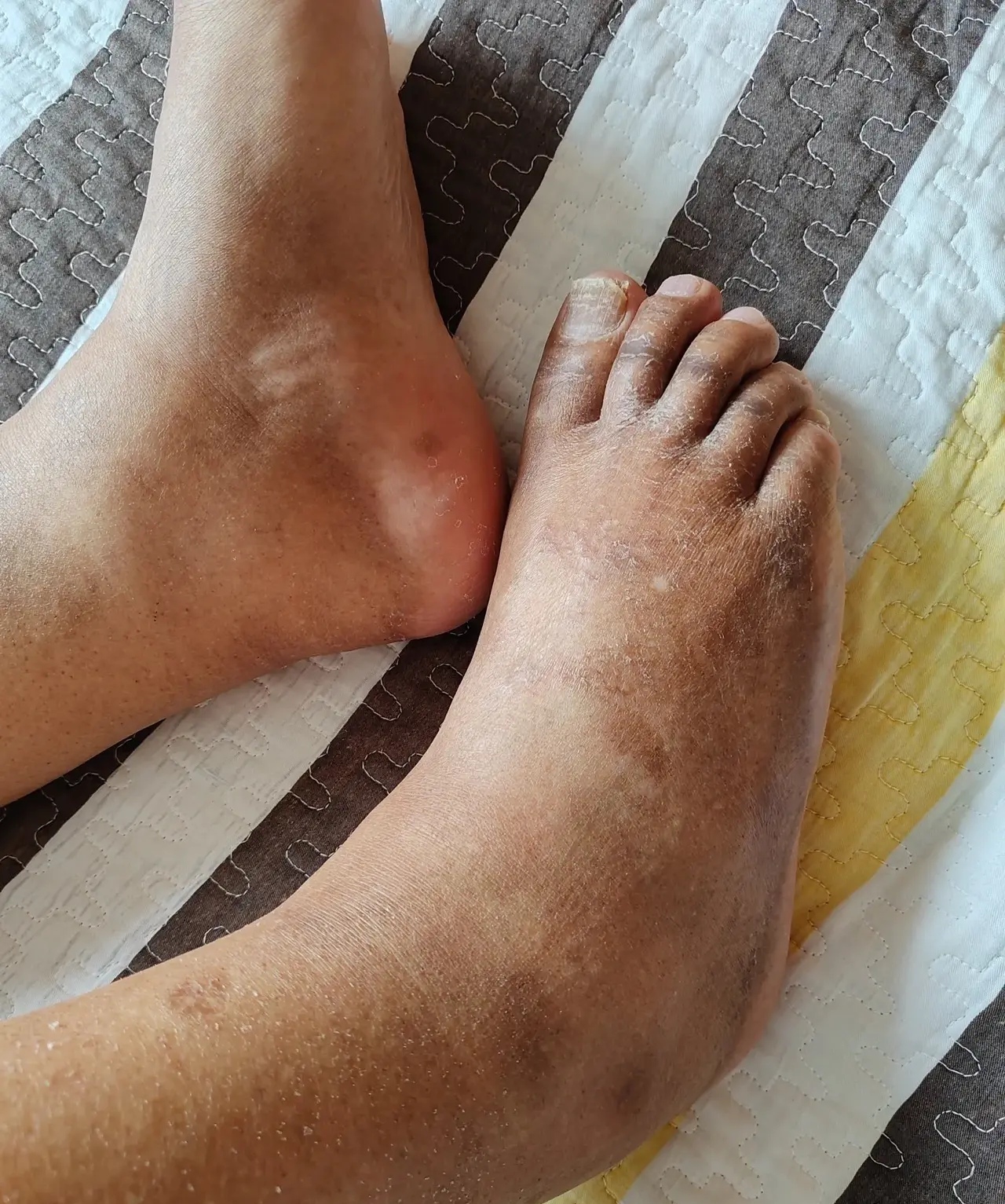 可这脚肿着咋回事嘛,就给开了利尿和补钾的药打发回家