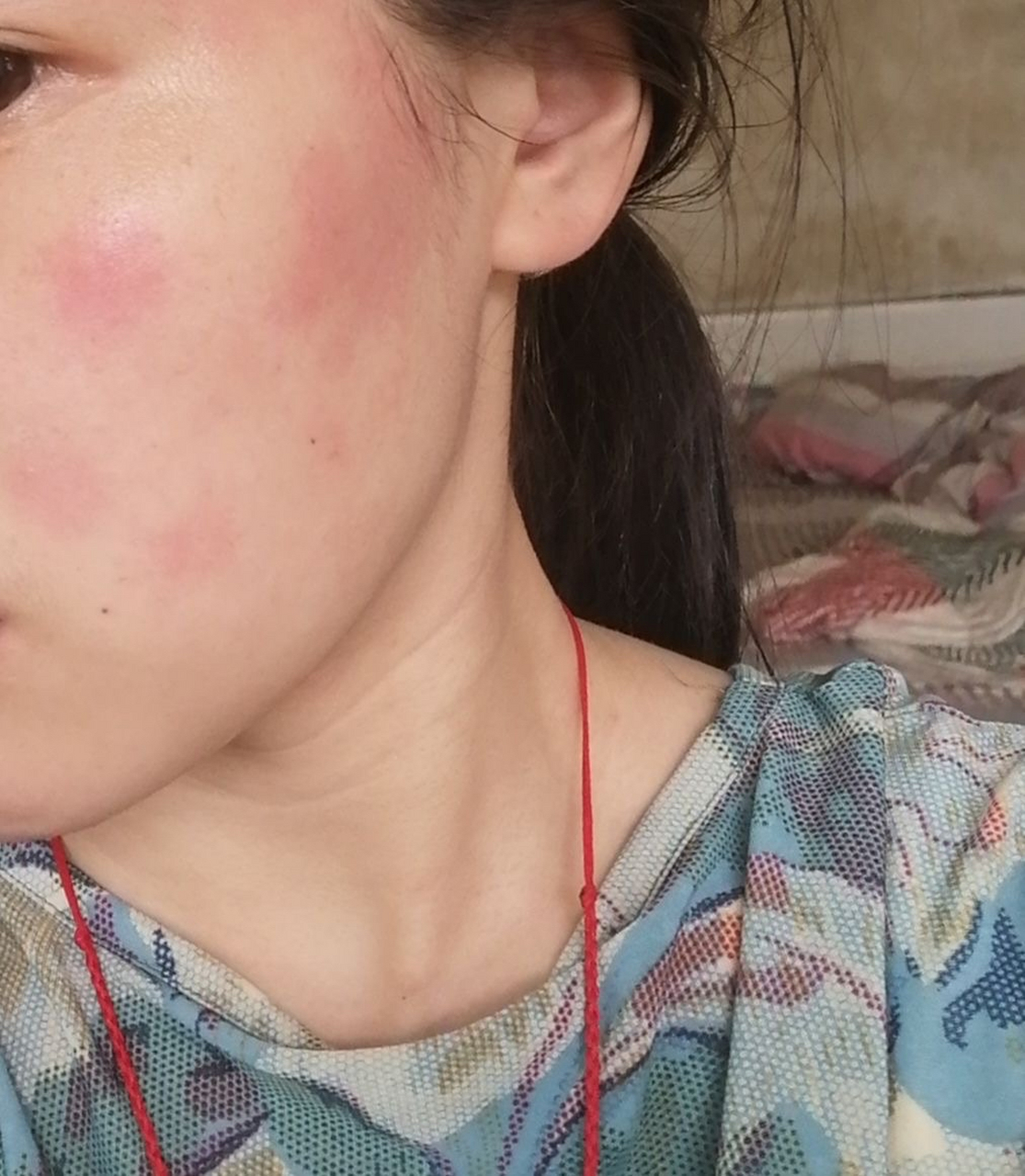 网友:为什么每次洗完脸都这样,好痒,用清水洗也是,洗面奶也是,按压轻