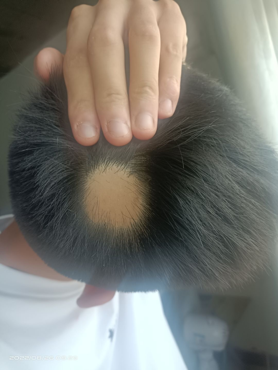求助,斑秃这种情况还能长出来么?会不会是假性斑秃