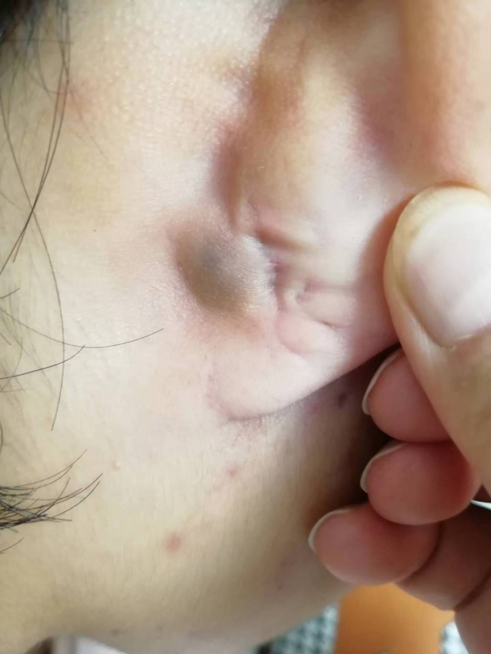 求助:耳朵后面长的,软软的,碰到有点疼,有哪个右友知道是啥嘛,求助