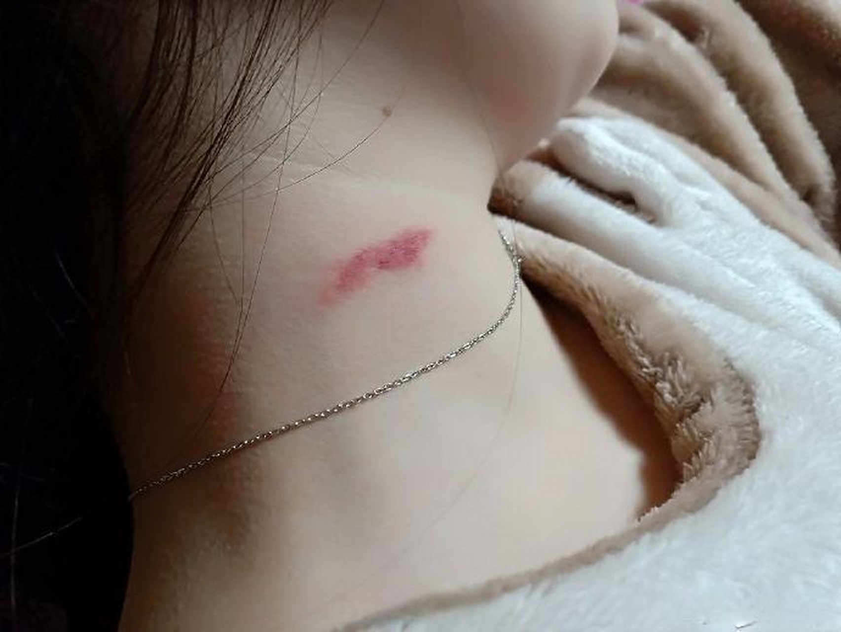 晚上睡觉的时候发现女朋友脖子上抓痕,是她自己挠的吗?