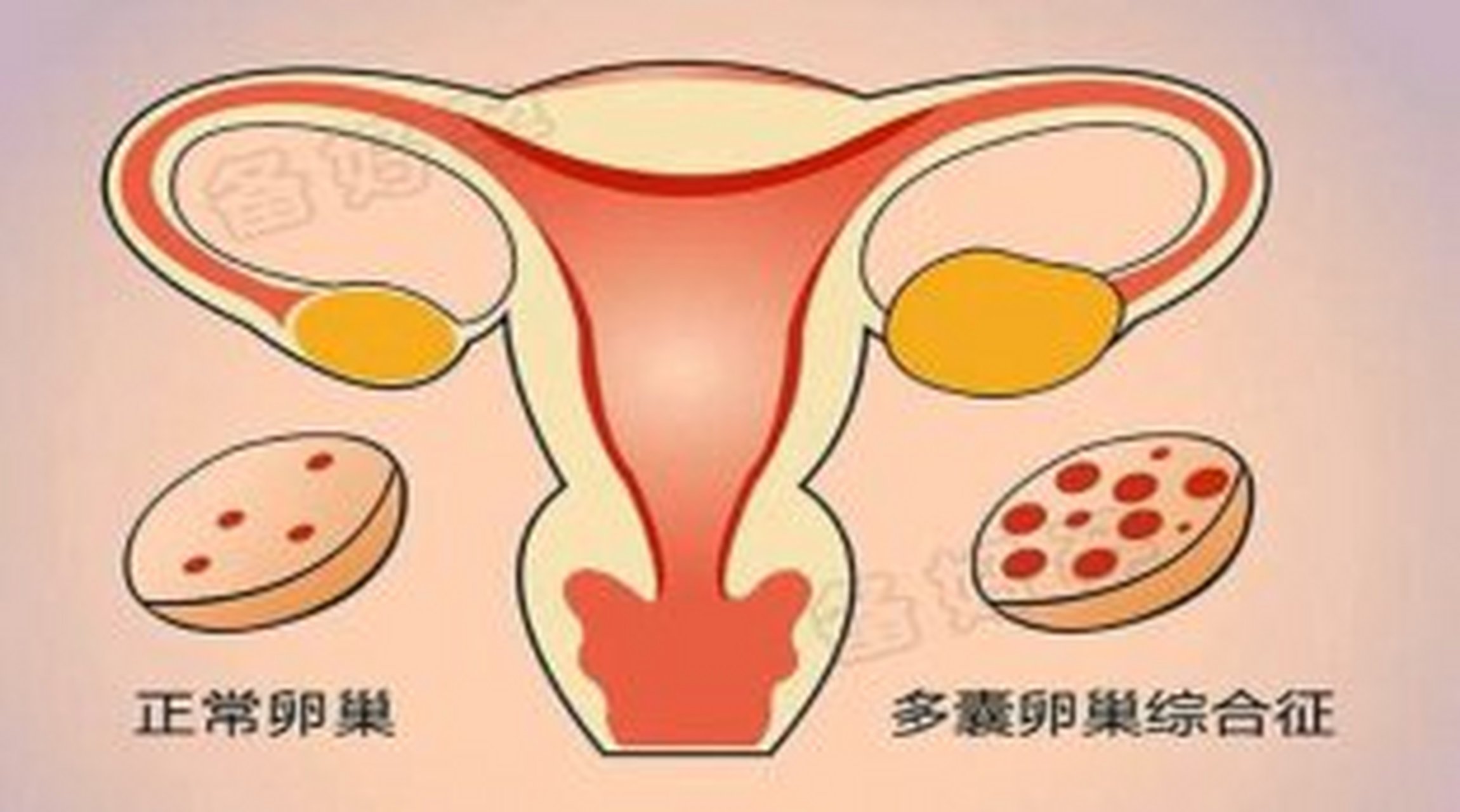 专心!多囊卵巢是什么原因引起的"满意的笑容"-第2张图片-纳米博客