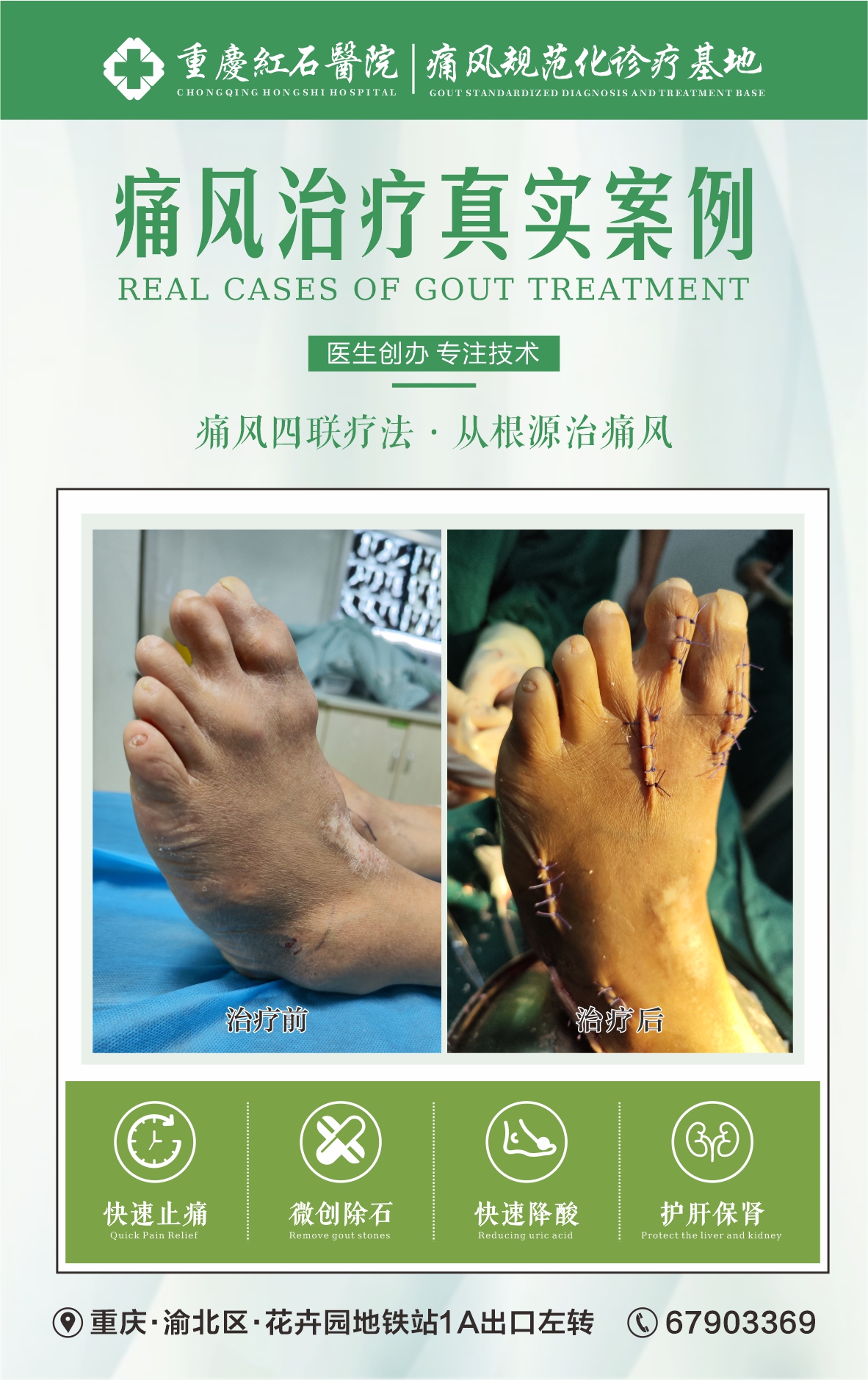 痛风治疗# 治痛风哪个医院好-痛风哪家医院治疗最好-重庆哪里恳以