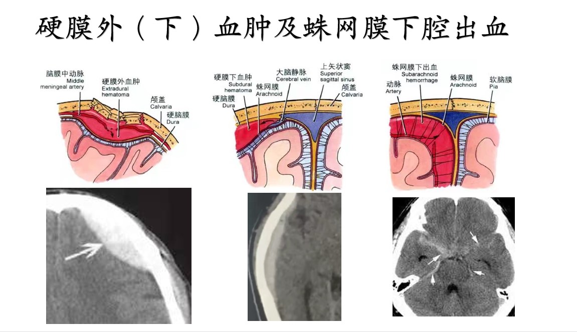 硬膜外(下)血肿及蛛网膜下腔出血