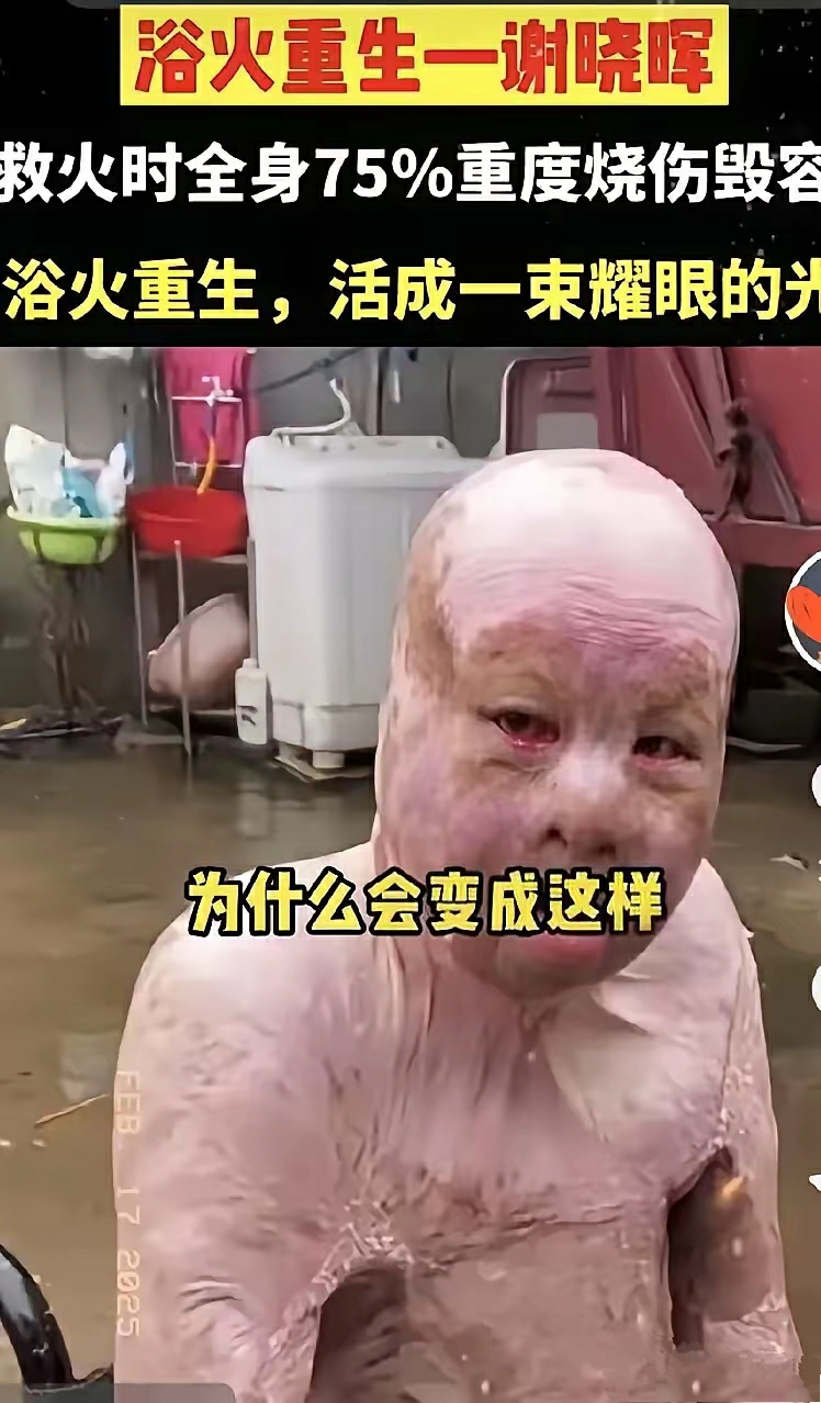 消防员烧伤毛毛大叔身上着火皮肤烧伤图片昆山爆炸事故后遗症人员图片