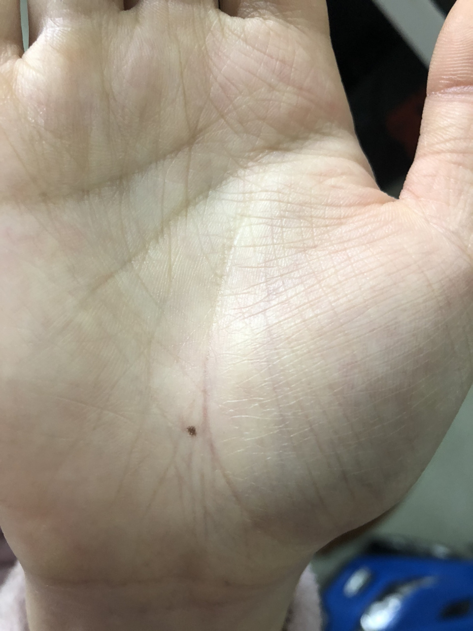 最近手心长了颗痣   求解.女