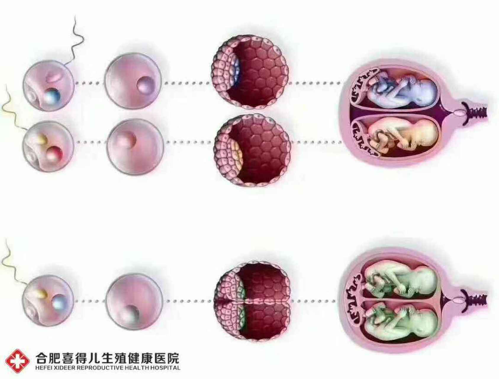 都是双胞胎为啥区别这么大 双胞胎分同卵和异卵两种,下图给您答案