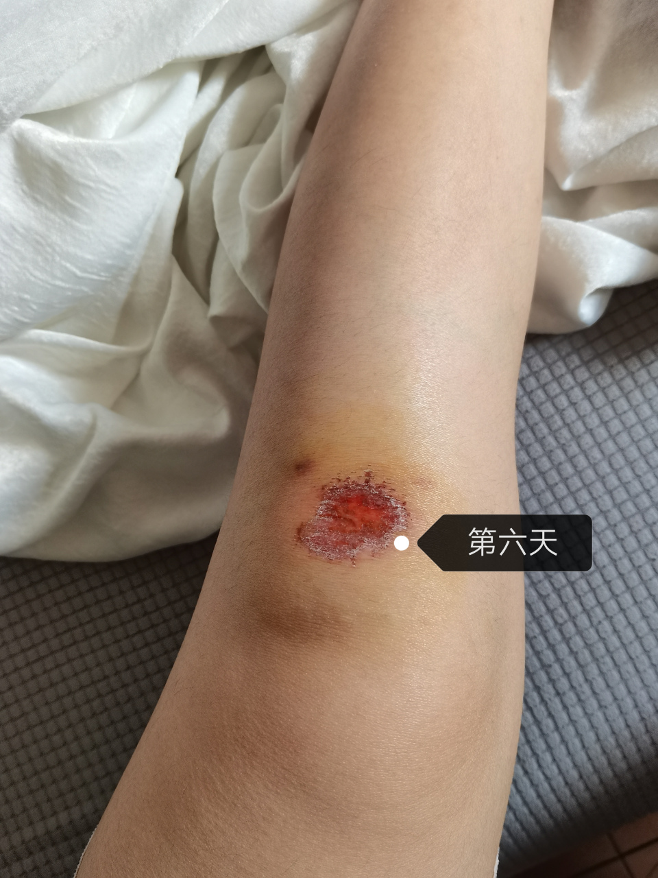 摔伤一定要及时正确的去处理伤口