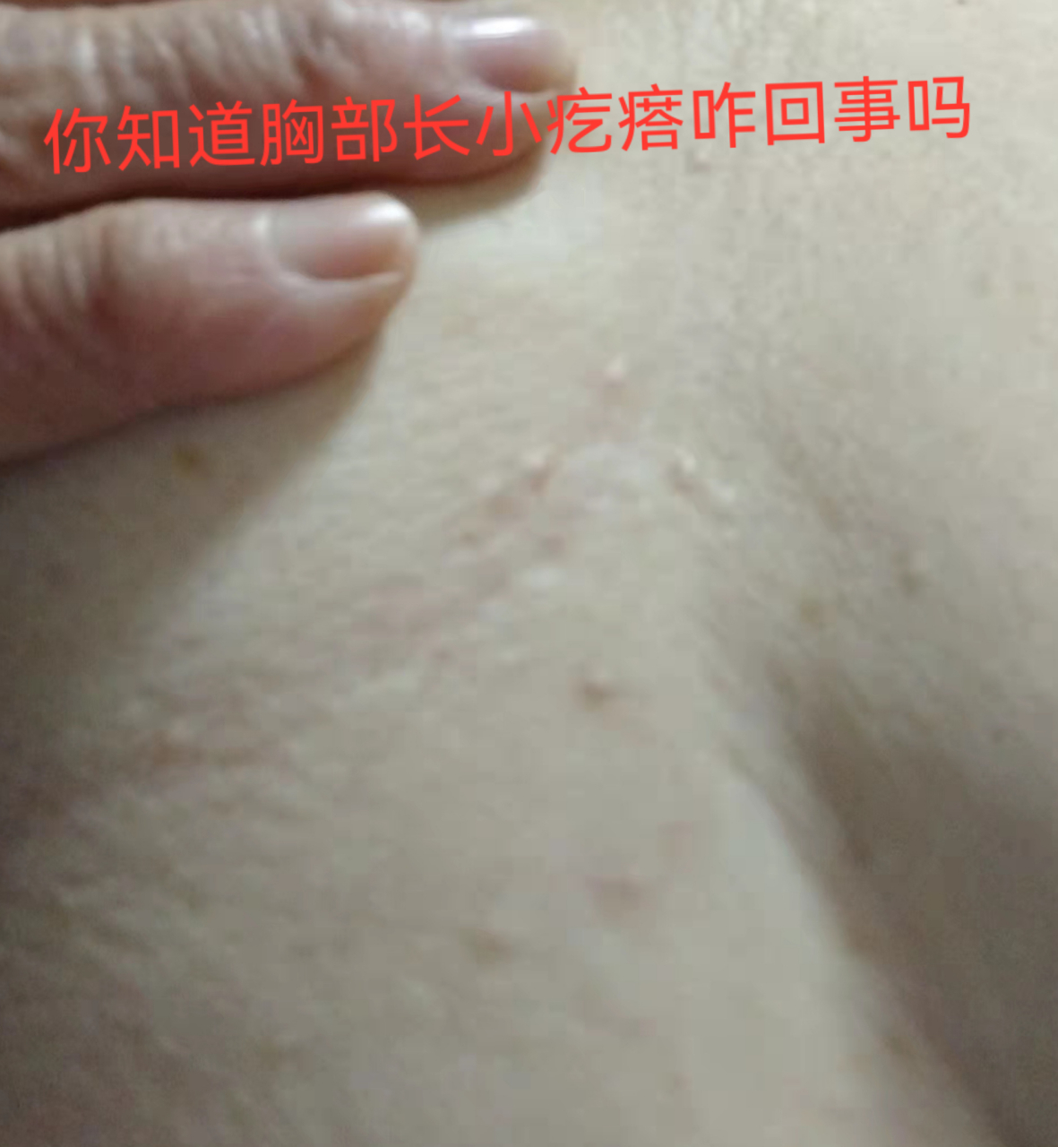 胸部长疙瘩是什么原因造成的 你知道是什么原因吗?
