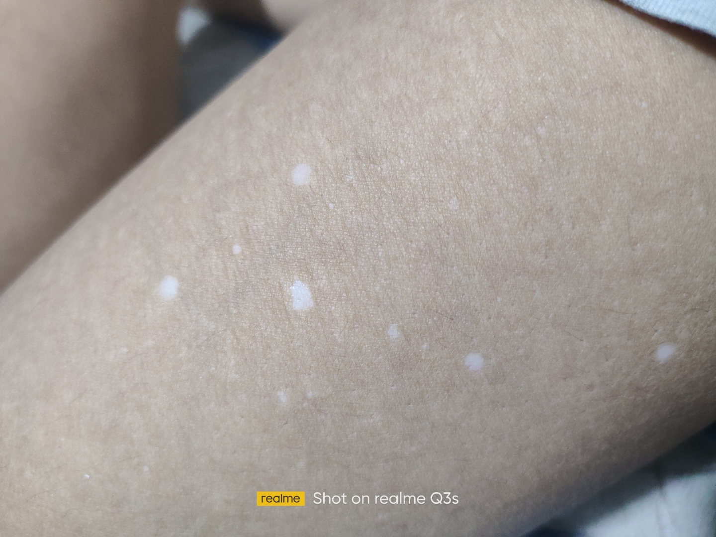 男人身上长这个白点怎么回事?