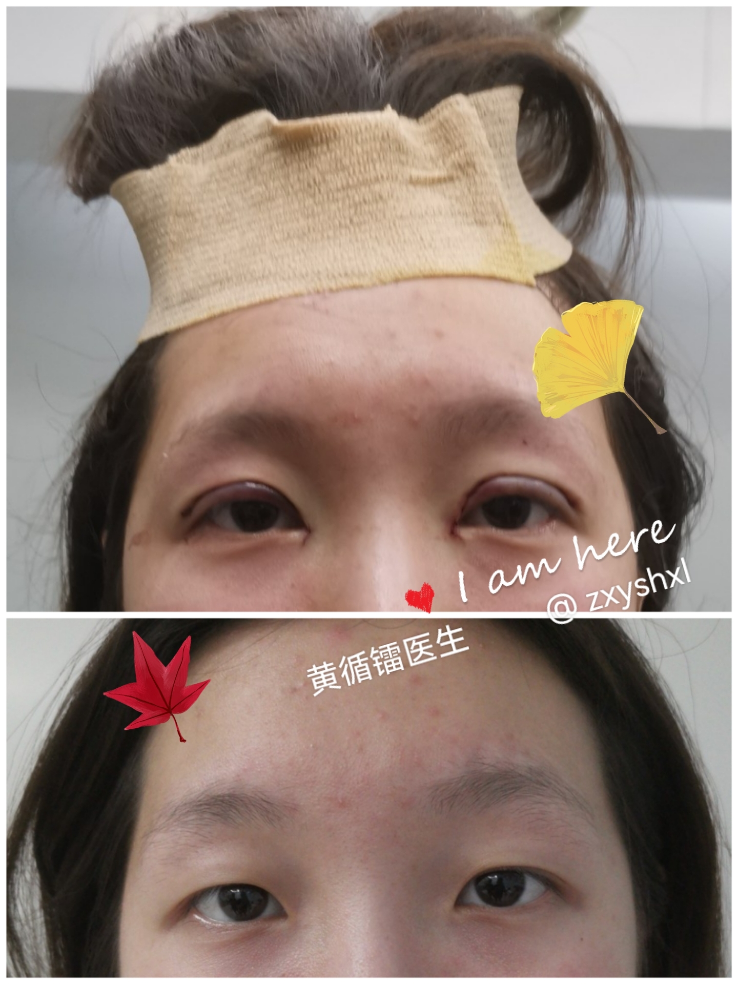 记录生活# #手术# #双眼皮# #隆胸# #我的美食分享