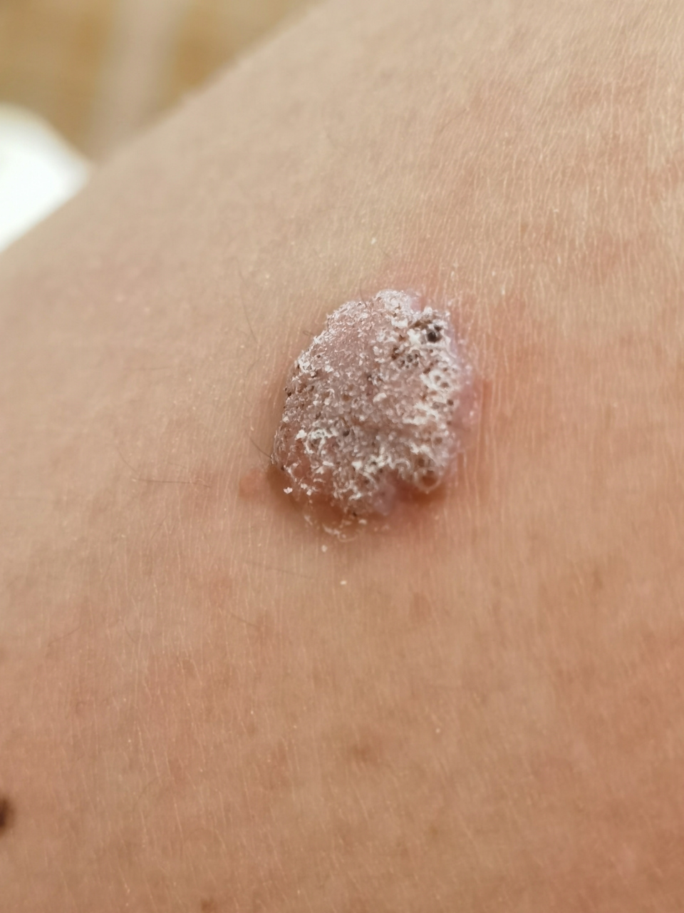 腿上长的这个是啥,是不是瘊子,怎么治