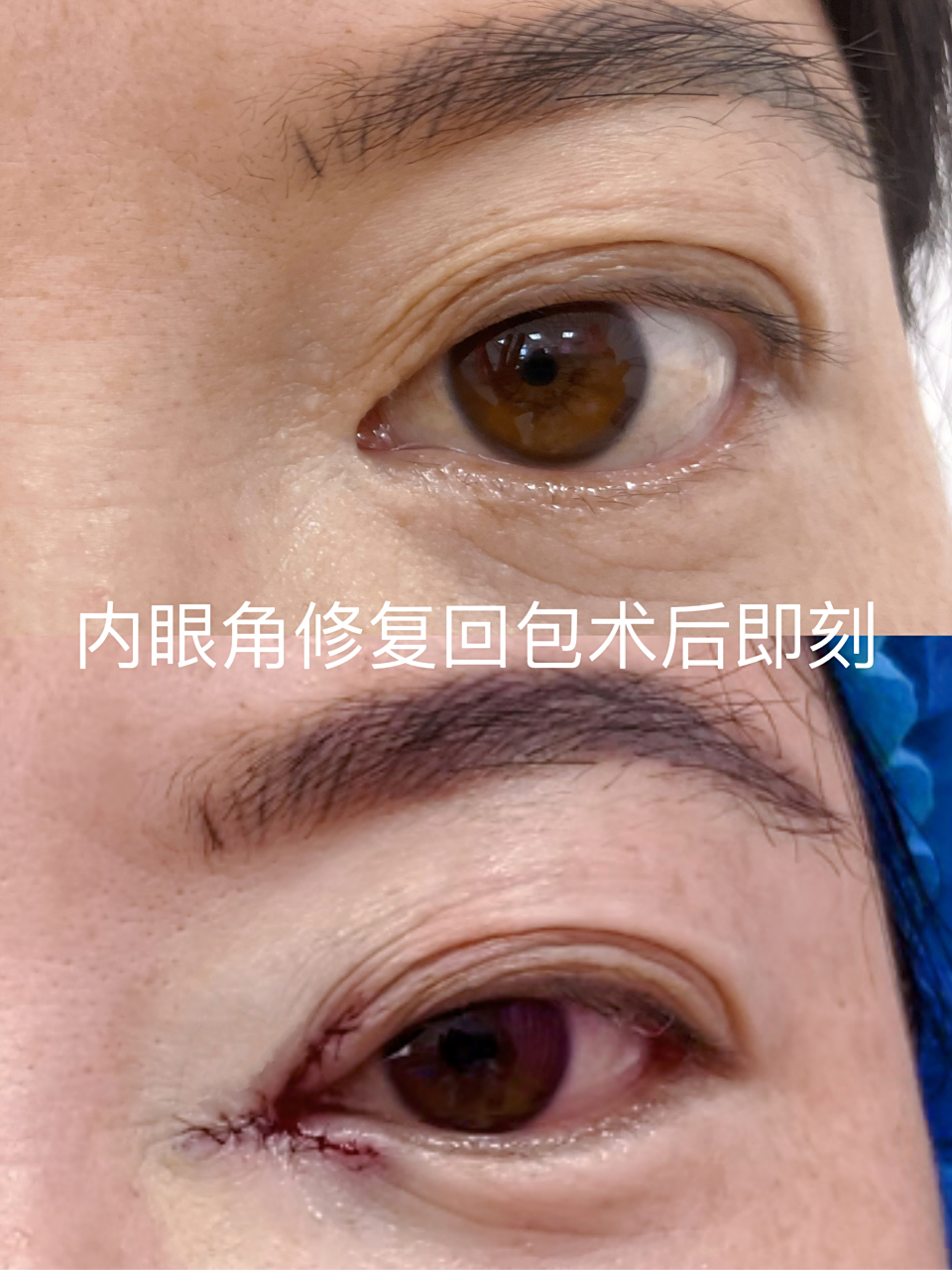 内眼角修复回包