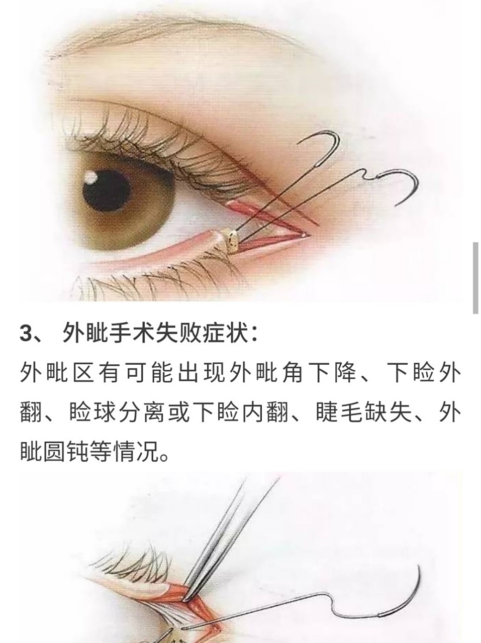 开外眼角术后一年,睑缘外翻,眼球分离,暴露性角膜炎.