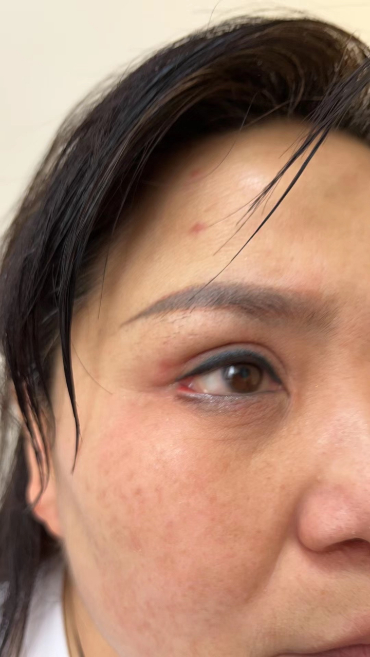 开外眼角术后一年,睑缘外翻,眼球分离,暴露性角膜炎.