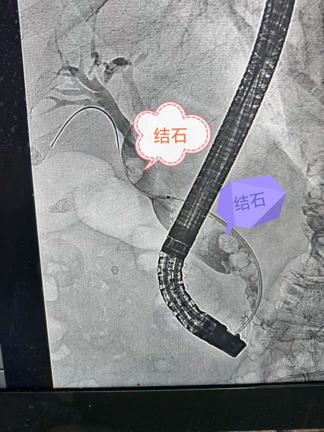 今天给98岁老奶奶顺利取出胆总管结石,#仁心计划健康笔记奋进赛