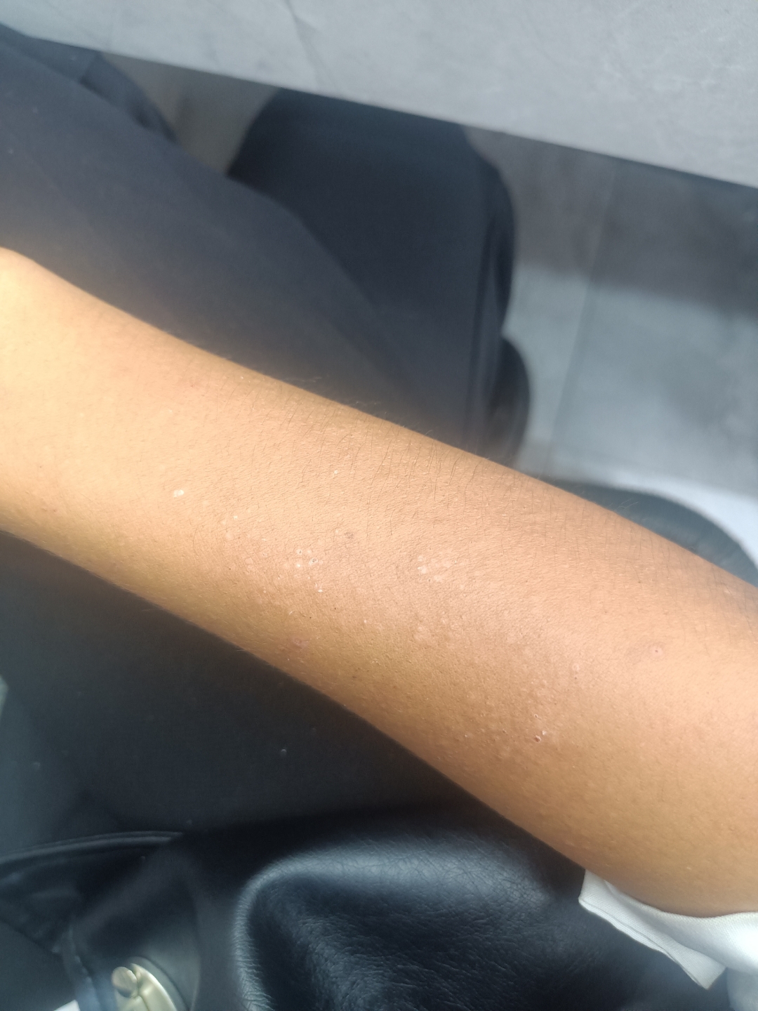 突然胳膊就起来这种东西,这是什么?会痒