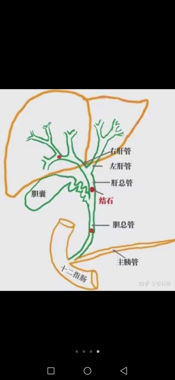 肝总管和胆总管示意图图片