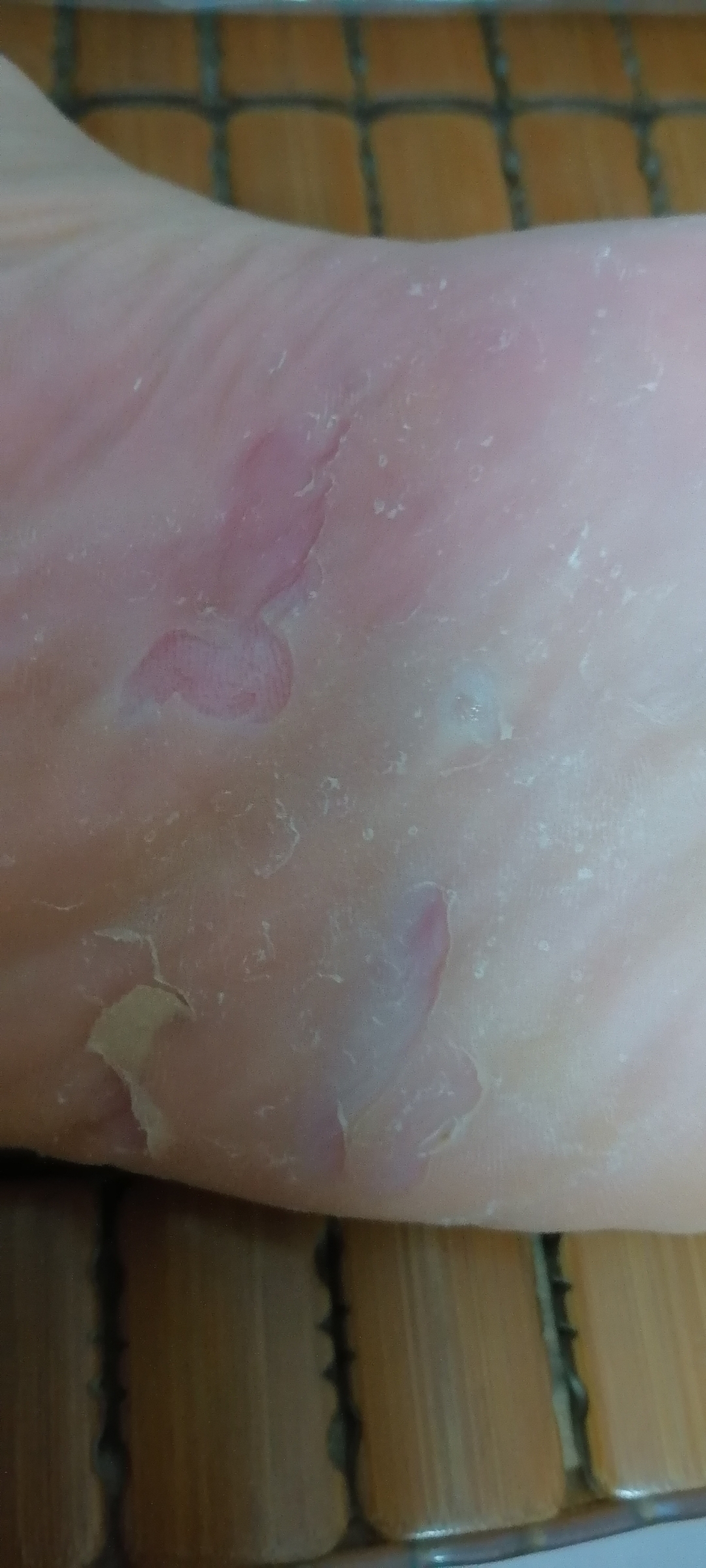 梅毒螺旋体没那么火邪了