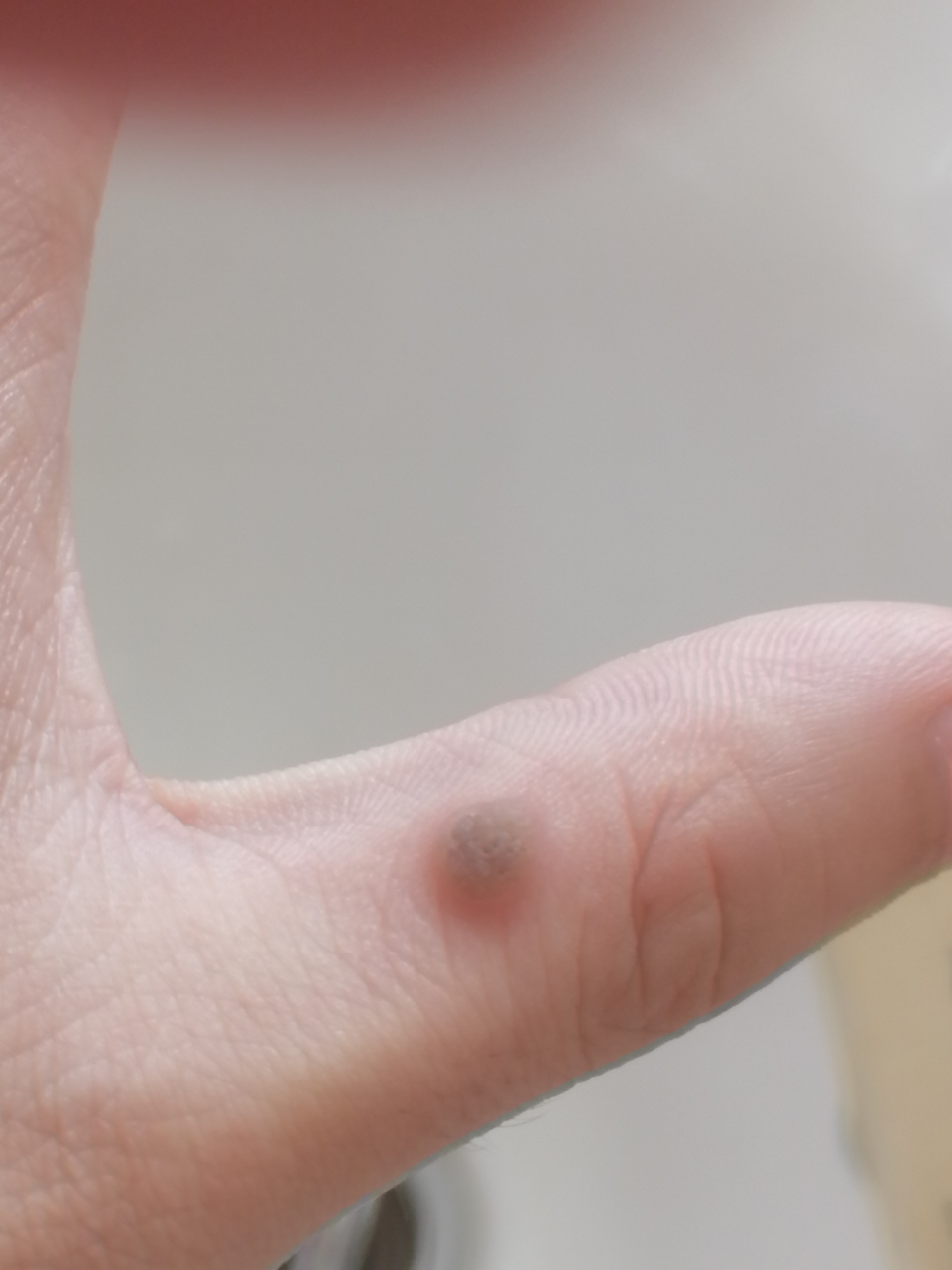 大家对寻常疣治疗有什么不懂的都可以问我哦.#寻常疣