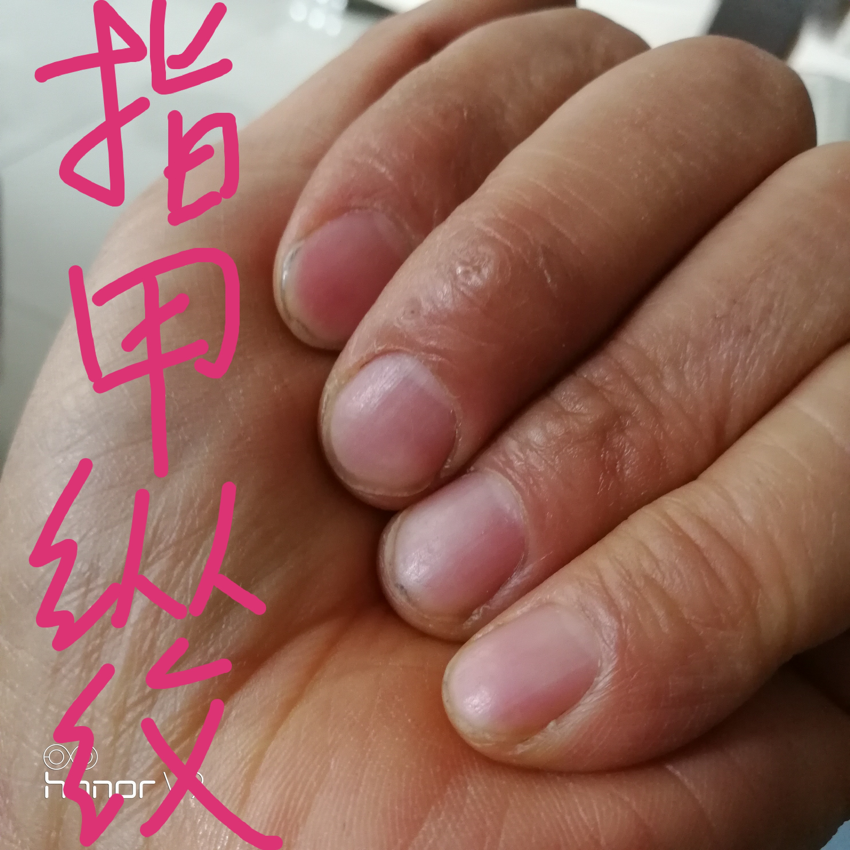 指甲纵纹,科普一下 :        指甲纵纹,是五脏受损的信号:(1)长期失眠