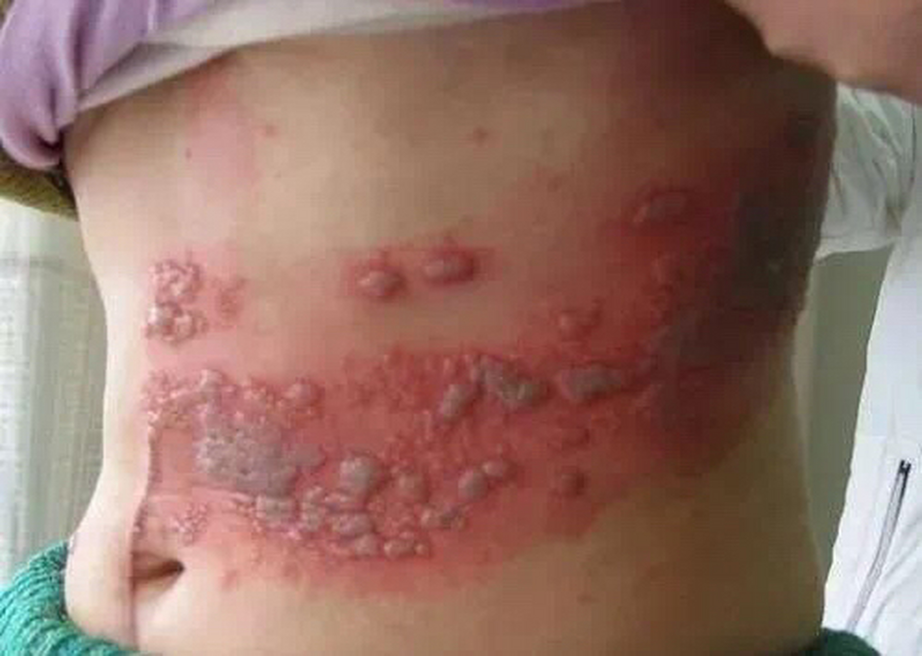 民间所说的蛇缠腰就是所说的蛇胆疮,也叫带状疱疹,因为这个病生长的