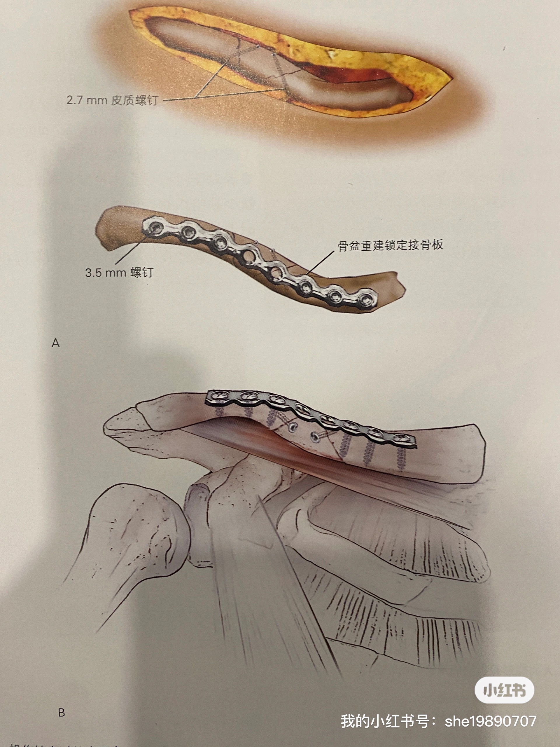 锁骨骨折愈合过程图片