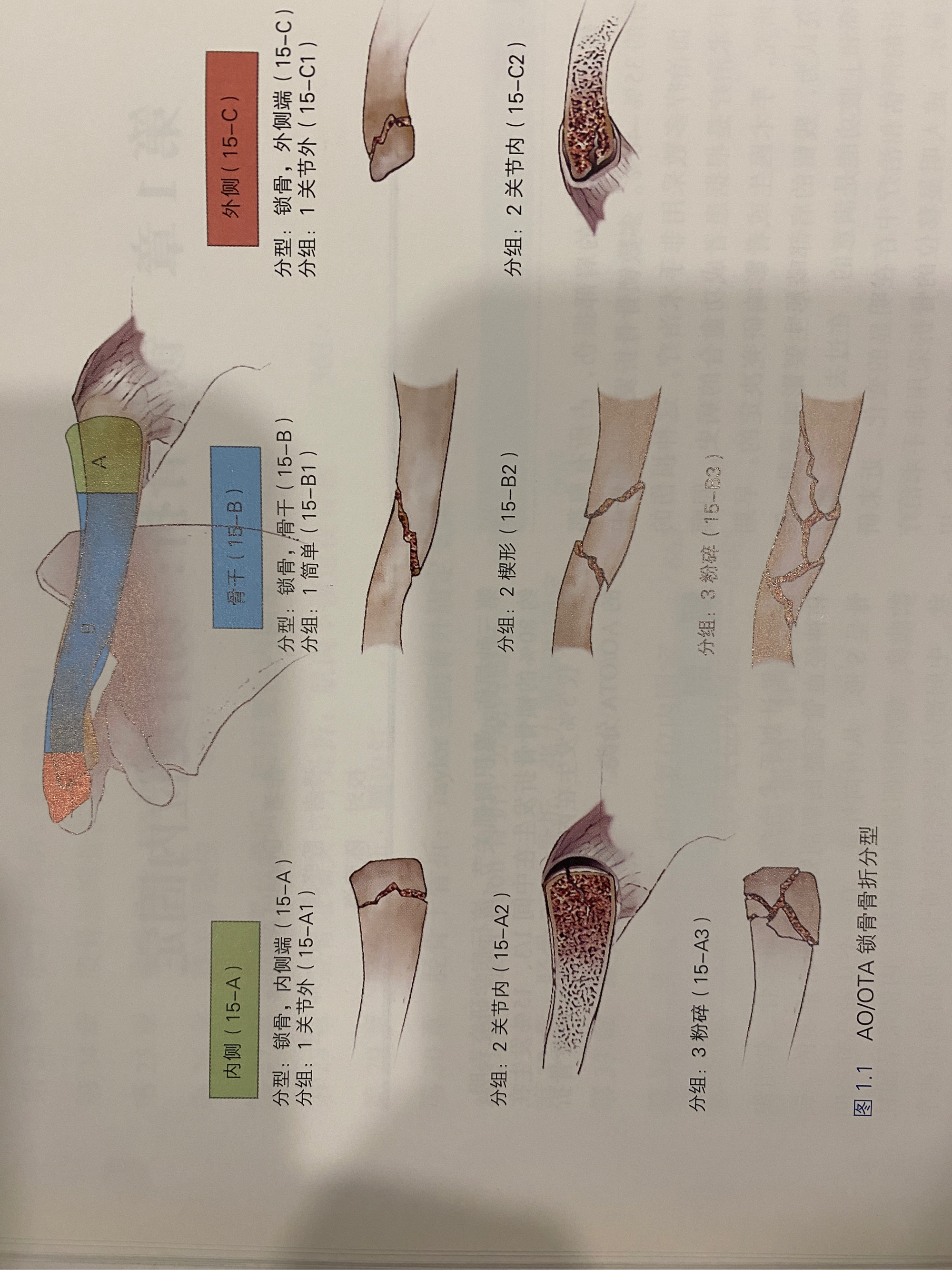 锁骨骨折外固定示意图图片