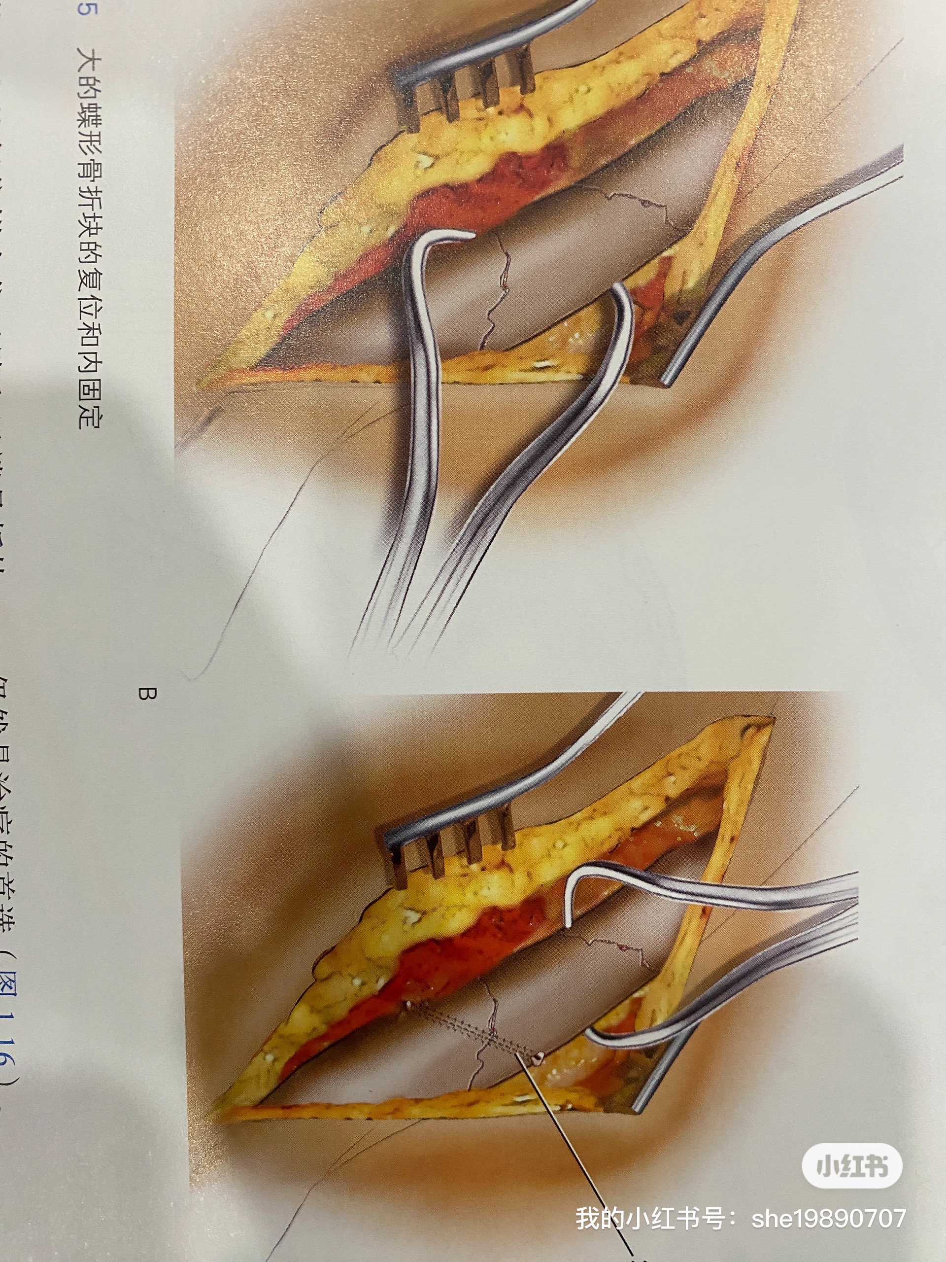 锁骨骨折愈合过程图片