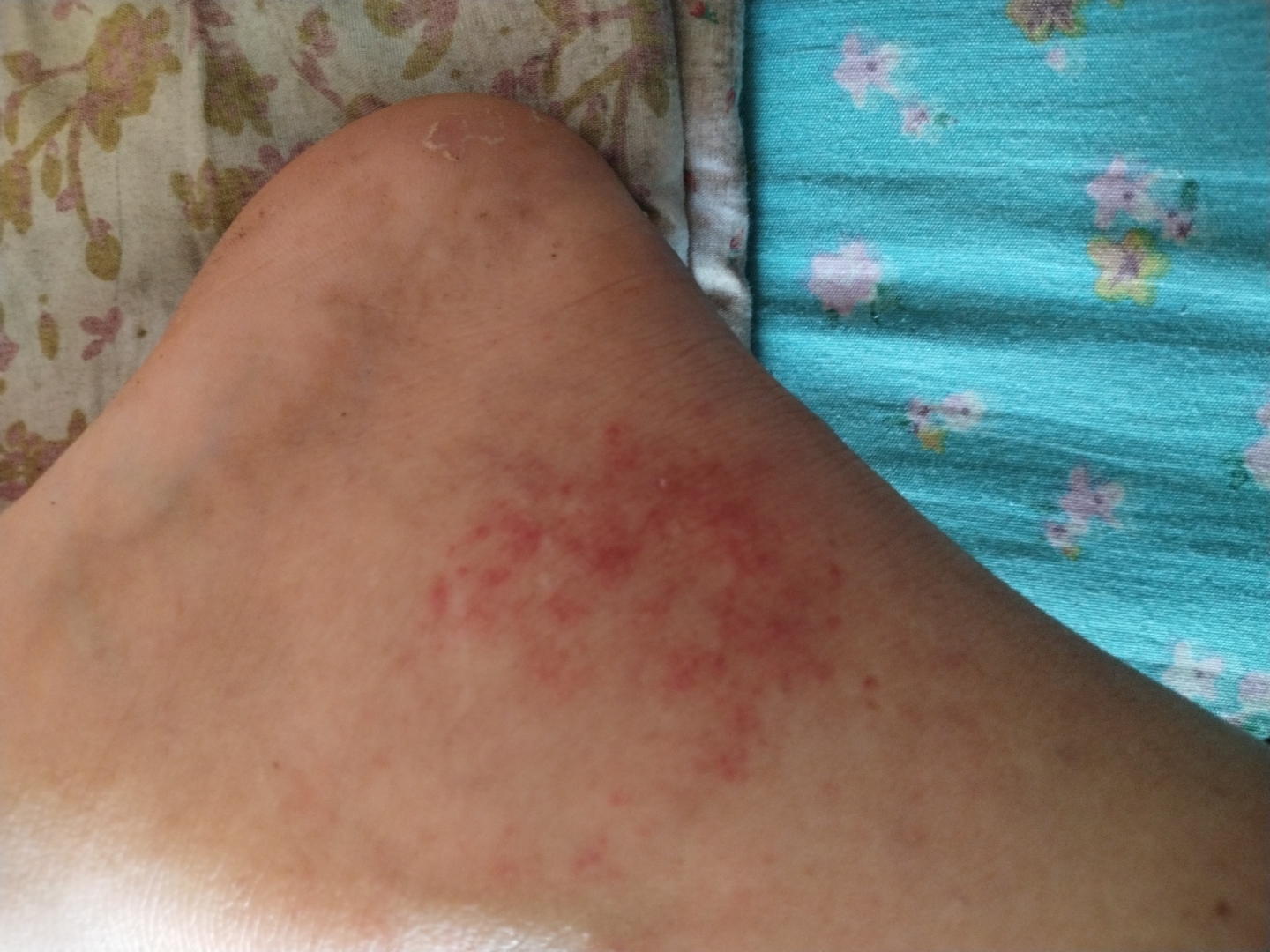 谁能帮我看看我这脚骨裂了这小红点是什么啊