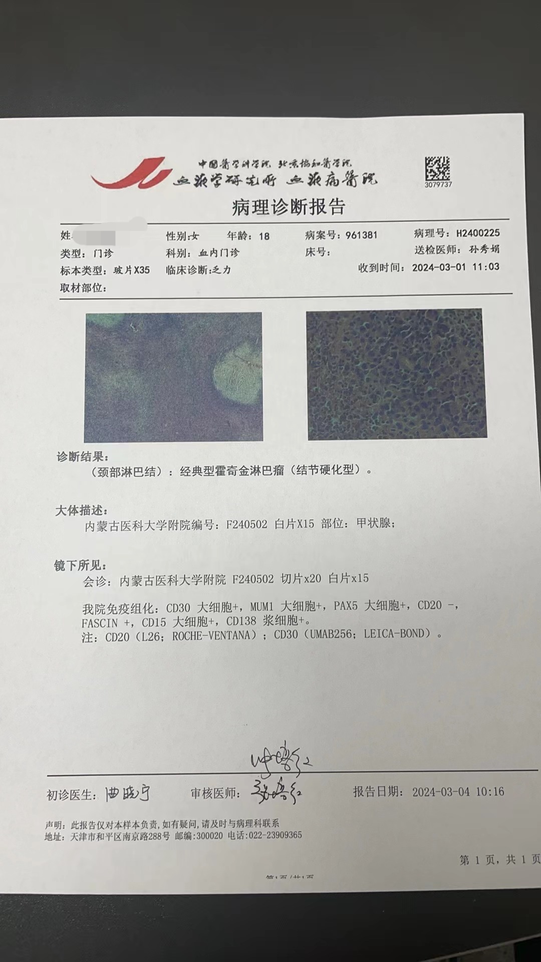 经典型霍奇金淋巴瘤(结节硬化型)4期正在做化疗2个疗程,也不知道什么