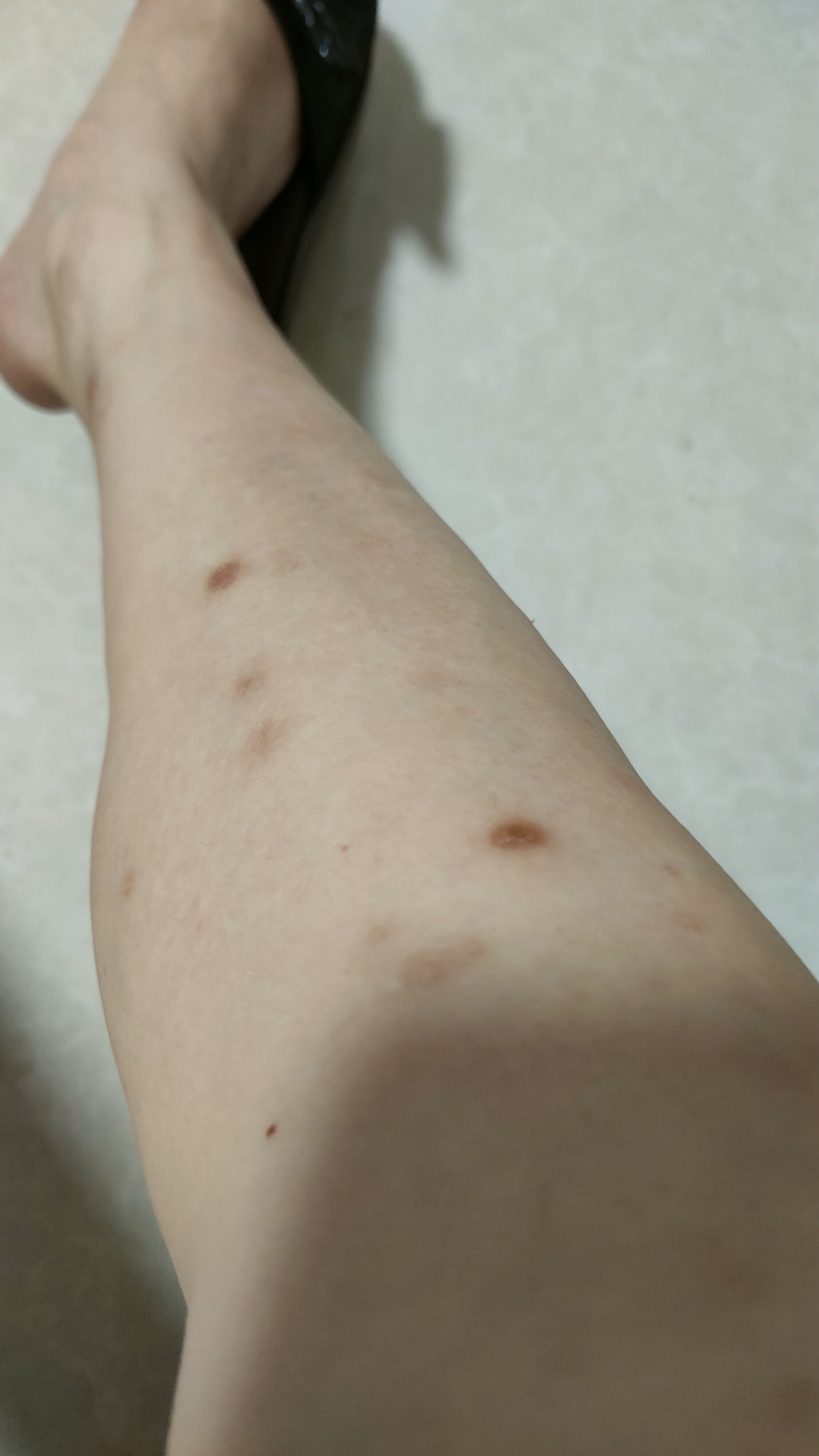 结节性痒疹有没有看好的 帮忙推荐一下