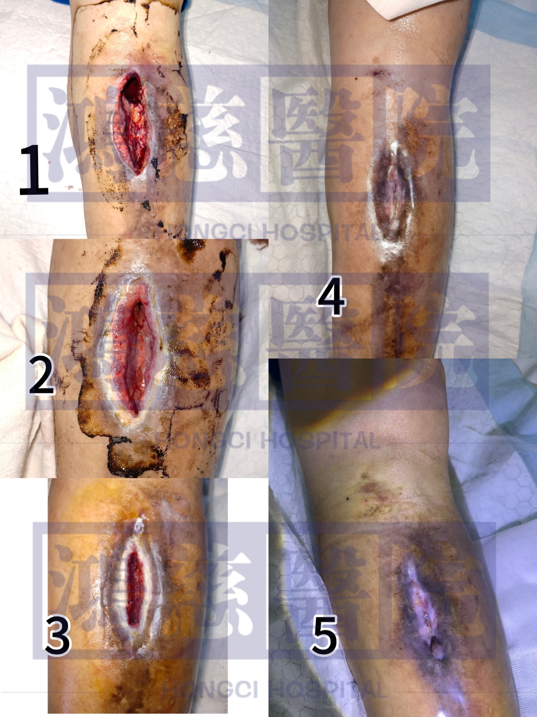 来自江苏的患者,2000年发生车祸,做了几次守术后